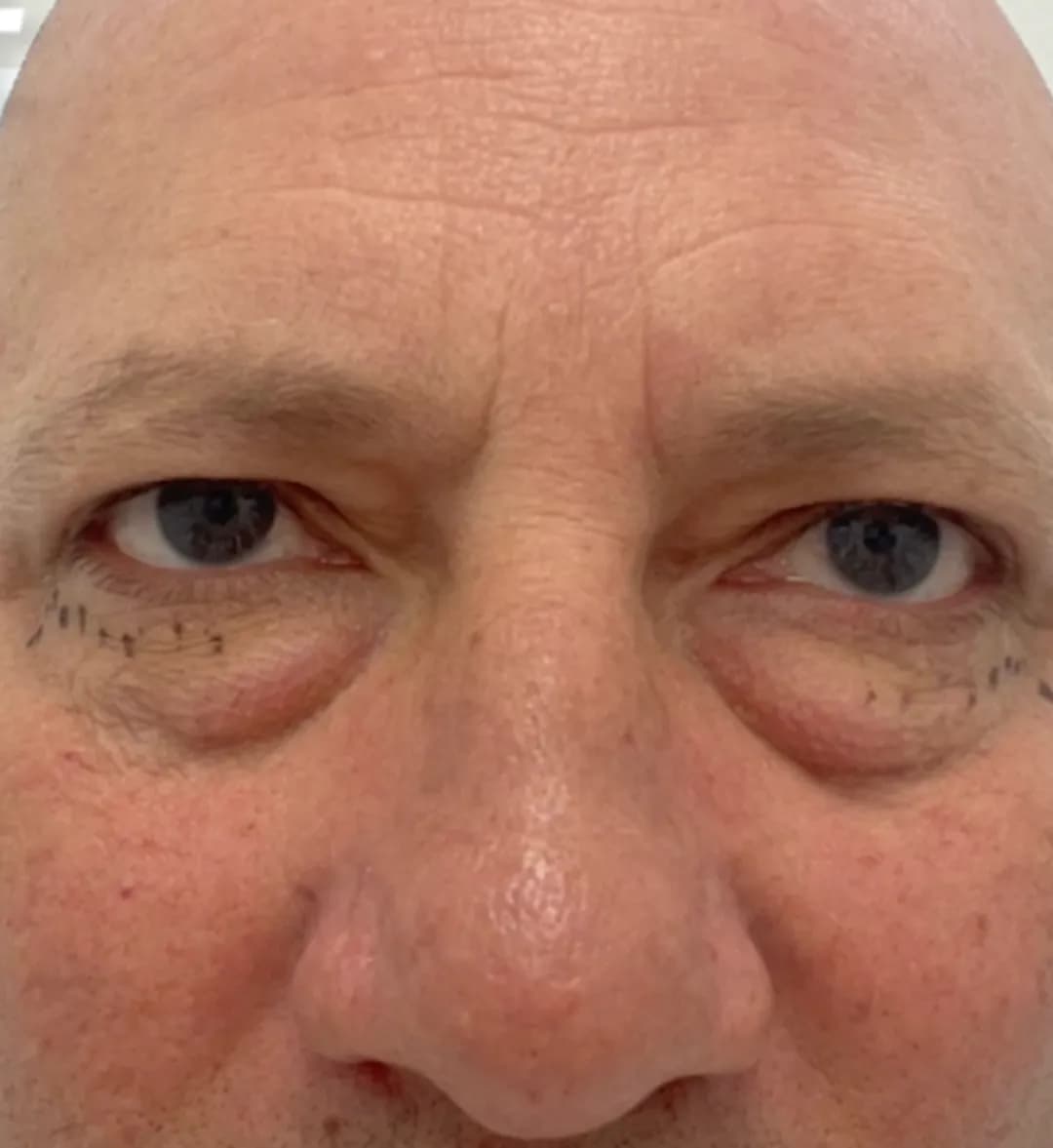 Face and neck procedures before by Dr. Oliver Simmons in Miami · Beautyland Plastic Surgery