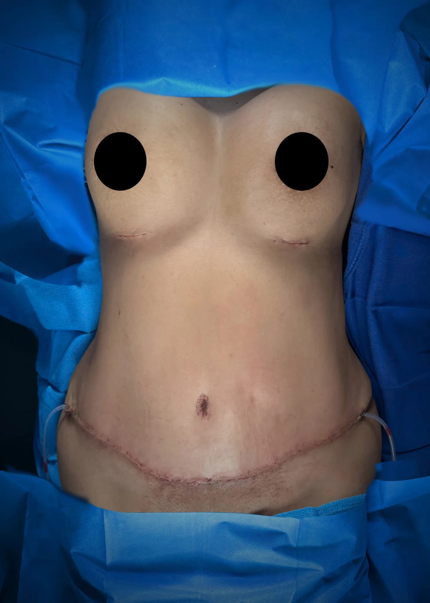 Mommy Makeover after by Dr. Anne-Sophie Lessard in Miami · Beautyland Plastic Surgery