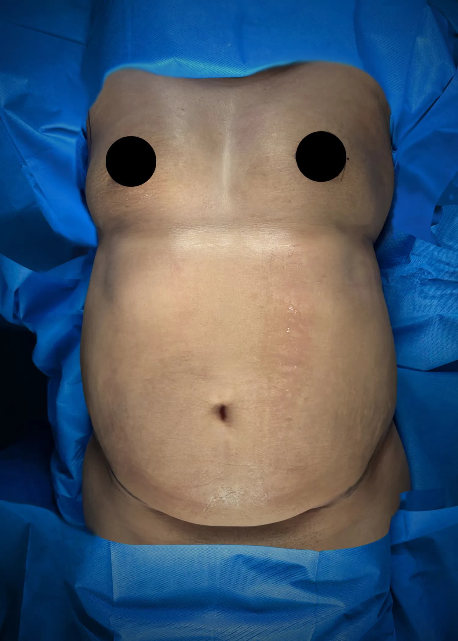 Mommy Makeover before by Dr. Anne-Sophie Lessard in Miami · Beautyland Plastic Surgery