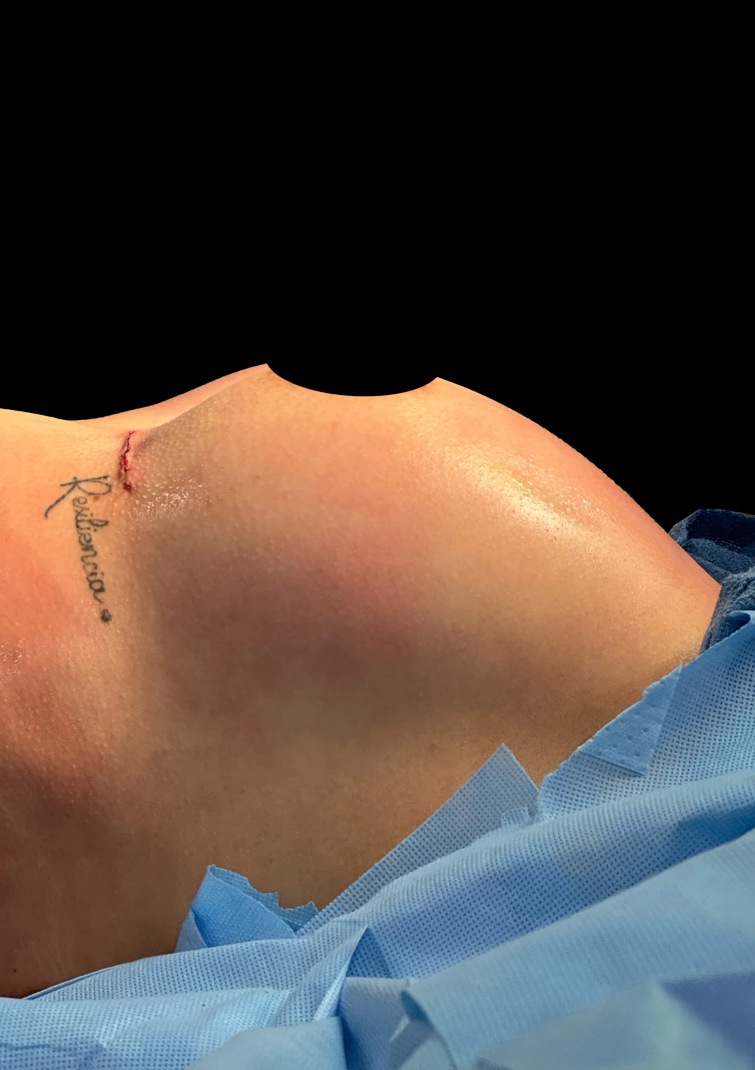 Breast Augmentation after · Dr. Oliver Simmons M.D, Miami