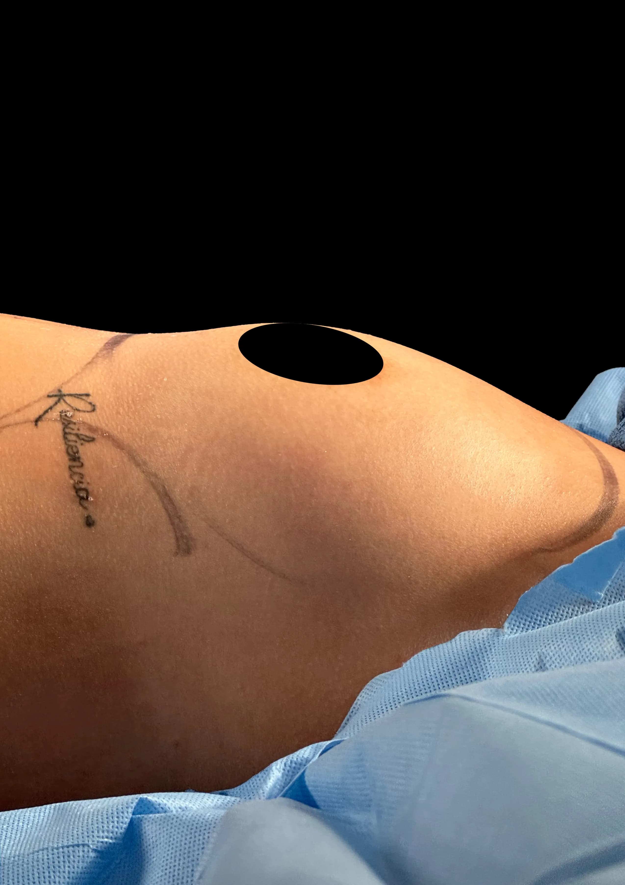 Breast Augmentation before · Dr. Oliver Simmons M.D, Miami