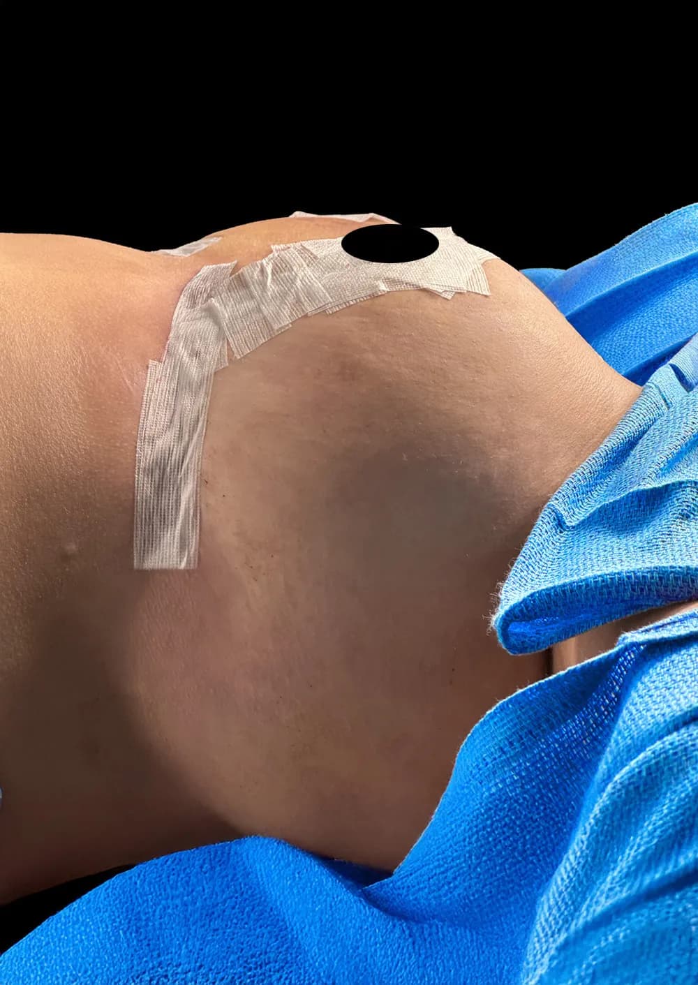 Breast Reduction after by Dr. Oliver Simmons in Miami · Beautyland Plastic Surgery