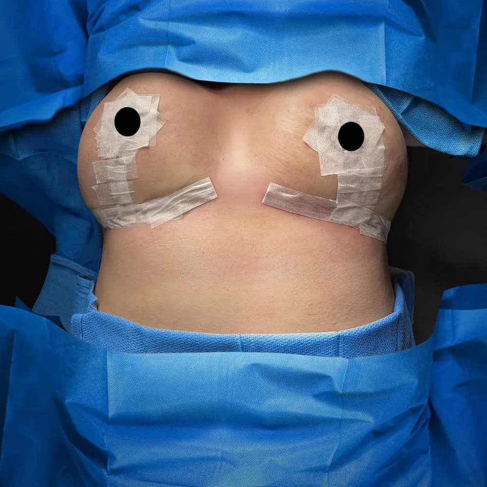 Breast Reduction after by Dr. Oliver Simmons in Miami · Beautyland Plastic Surgery