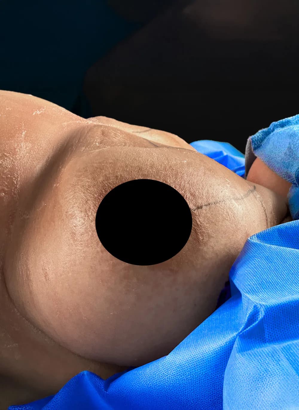 Breast Reduction before by Dr. Oliver Simmons in Miami · Beautyland Plastic Surgery