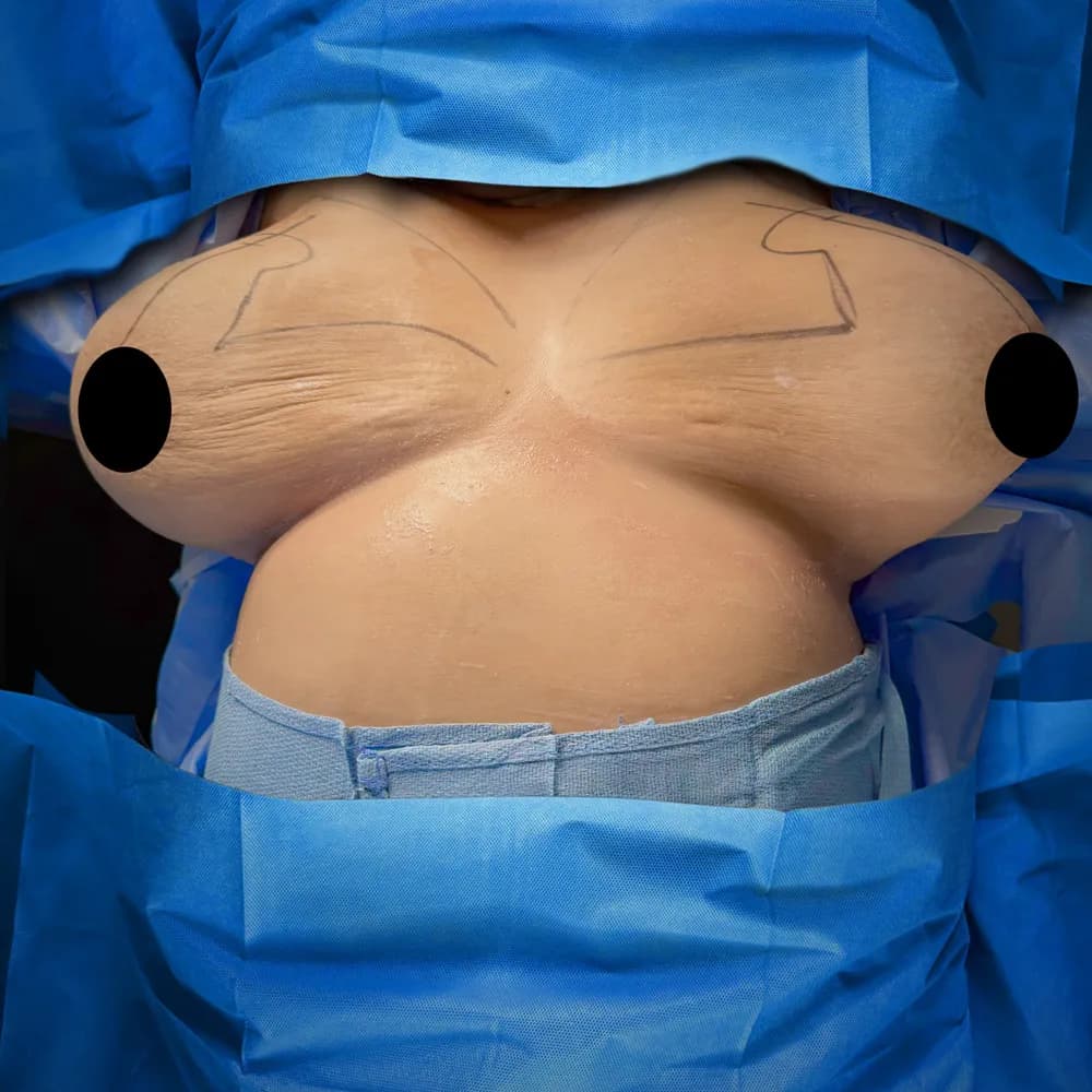Breast Reduction before by Dr. Oliver Simmons in Miami · Beautyland Plastic Surgery
