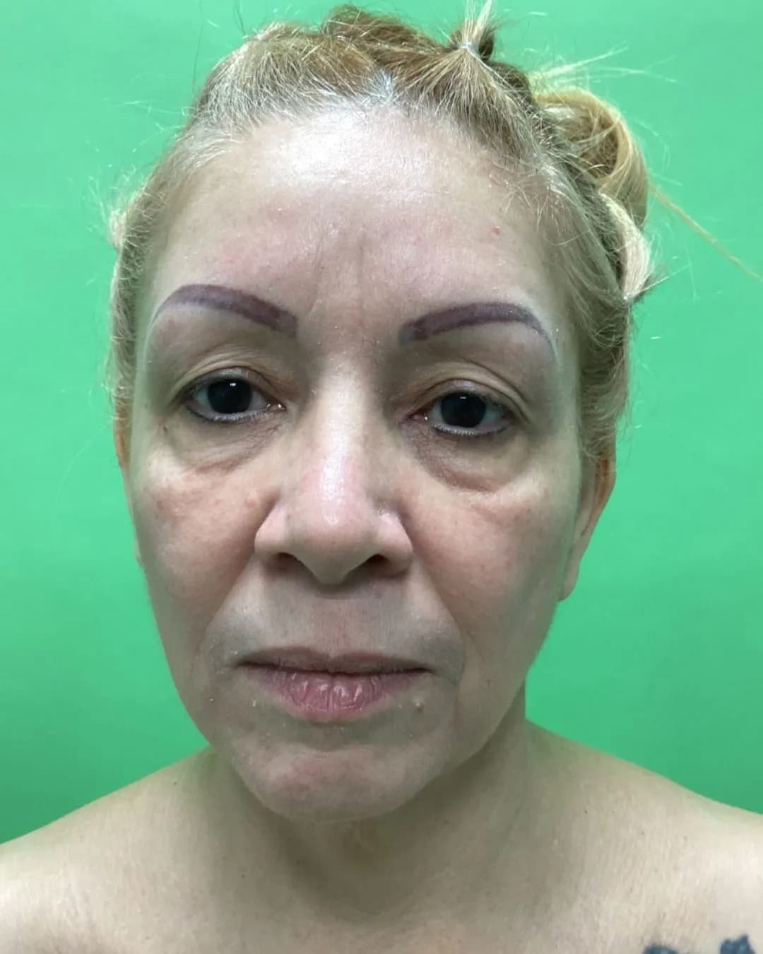 Rostro y cuello antes por Dr. Oliver Simmons en Miami · Beautyland Plastic Surgery