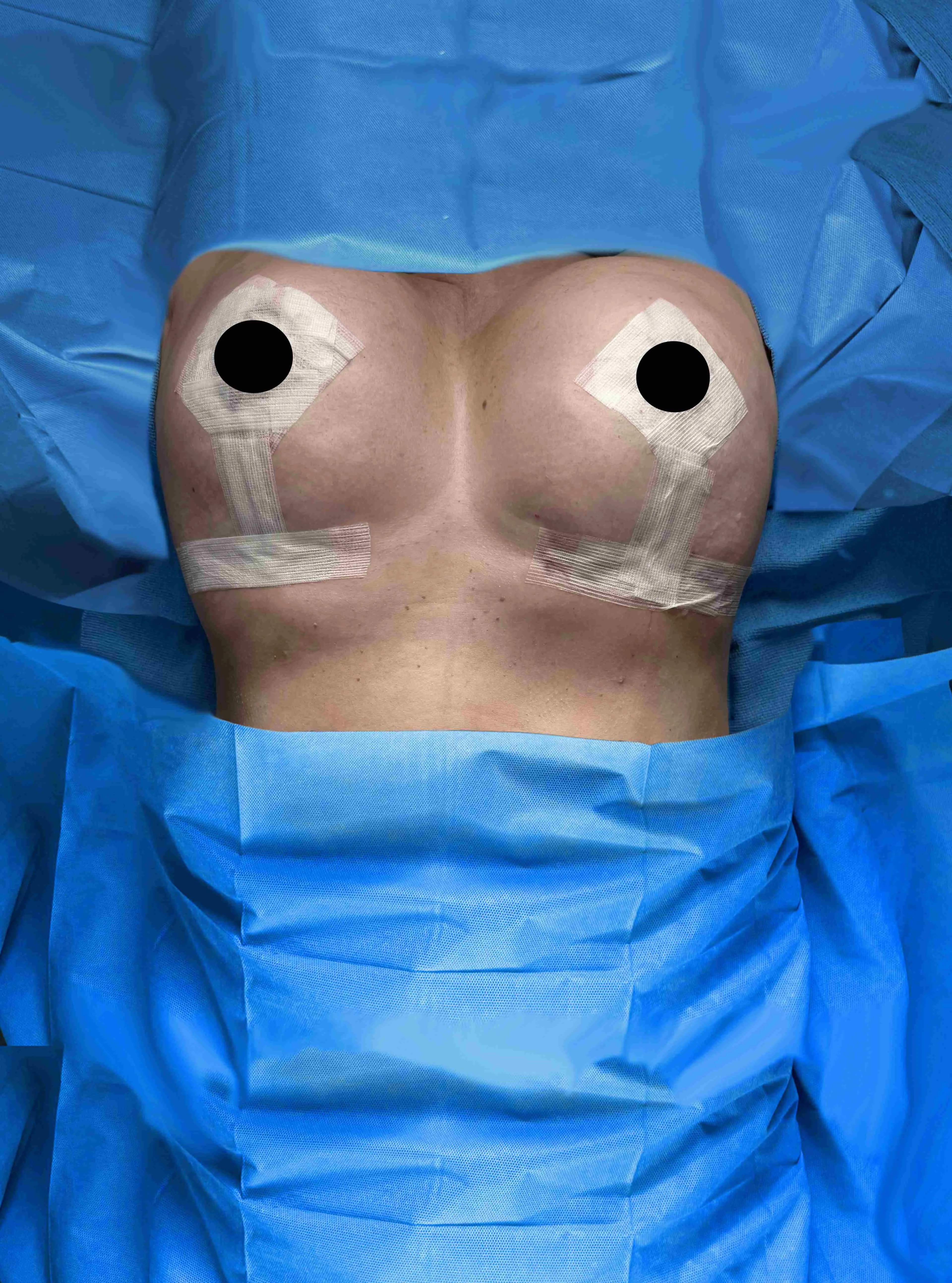 Breast Lift after by Dr. Anne-Sophie Lessard in Miami · Beautyland Plastic Surgery