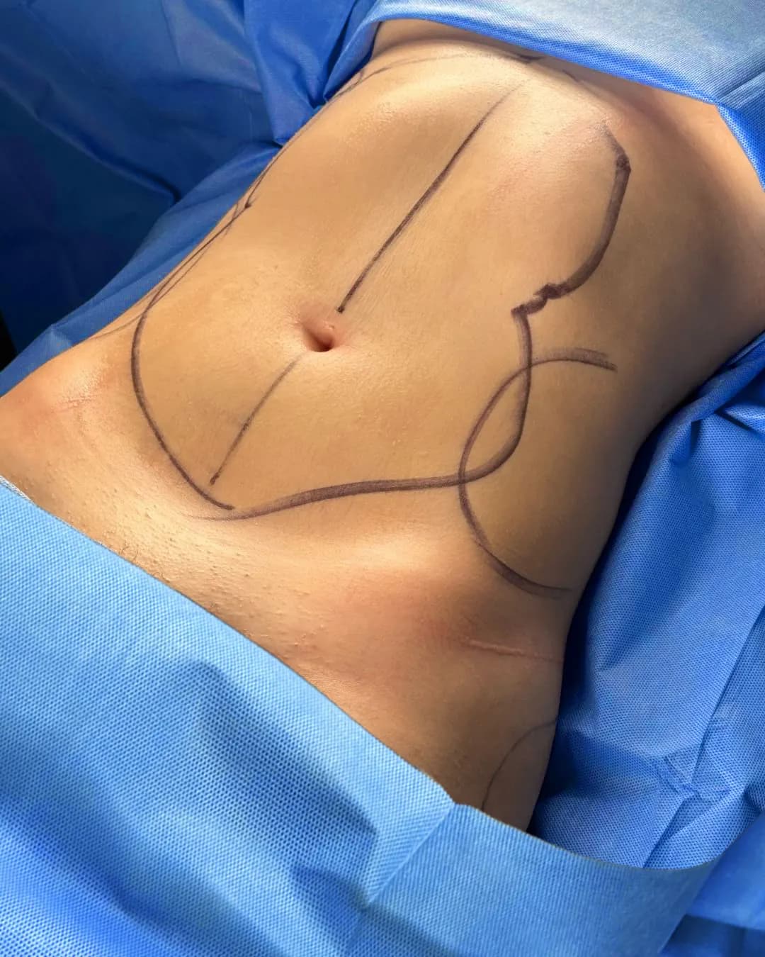 Liposuction & Lipo 360 before by Dr. Oliver Simmons in Miami · Beautyland Plastic Surgery