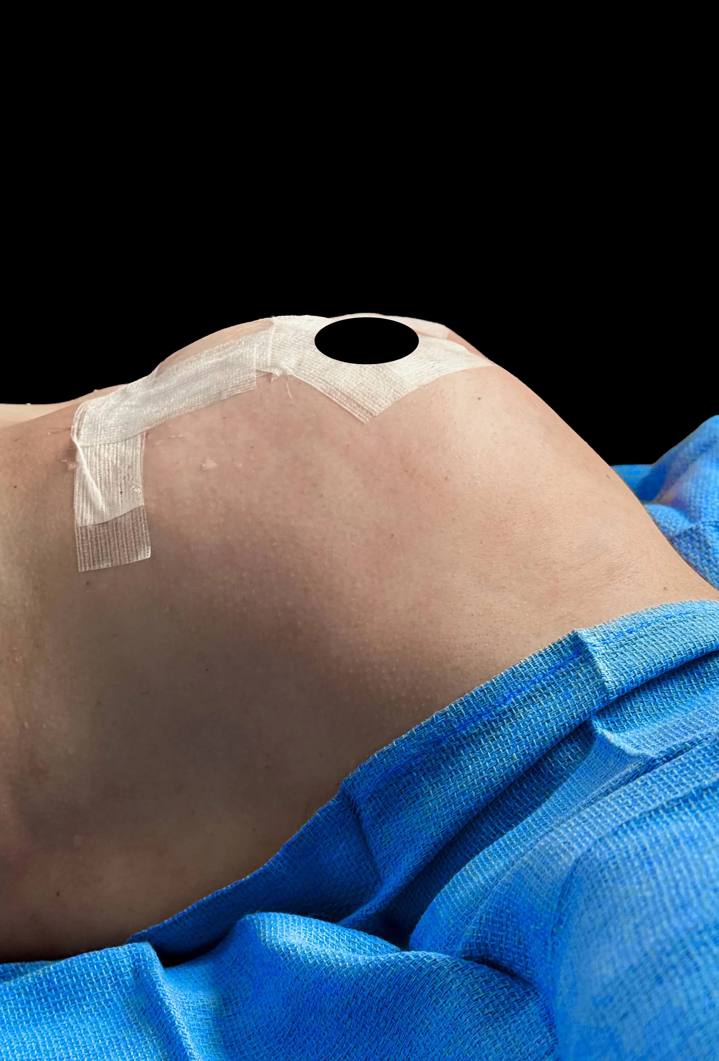 Breast Lift after by Dr. Anne-Sophie Lessard in Miami · Beautyland Plastic Surgery