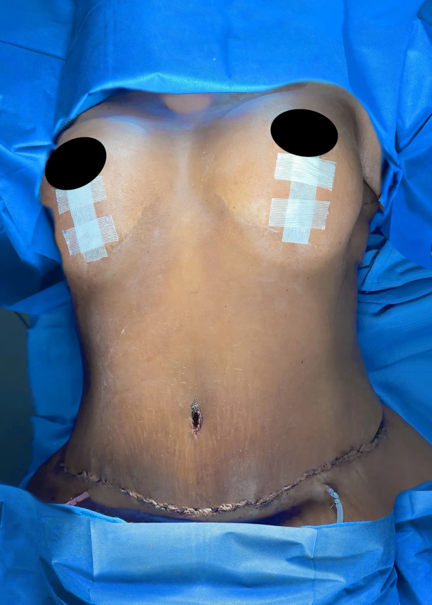 Mommy Makeover después por Dr. Oliver Simmons en Miami · Beautyland Plastic Surgery