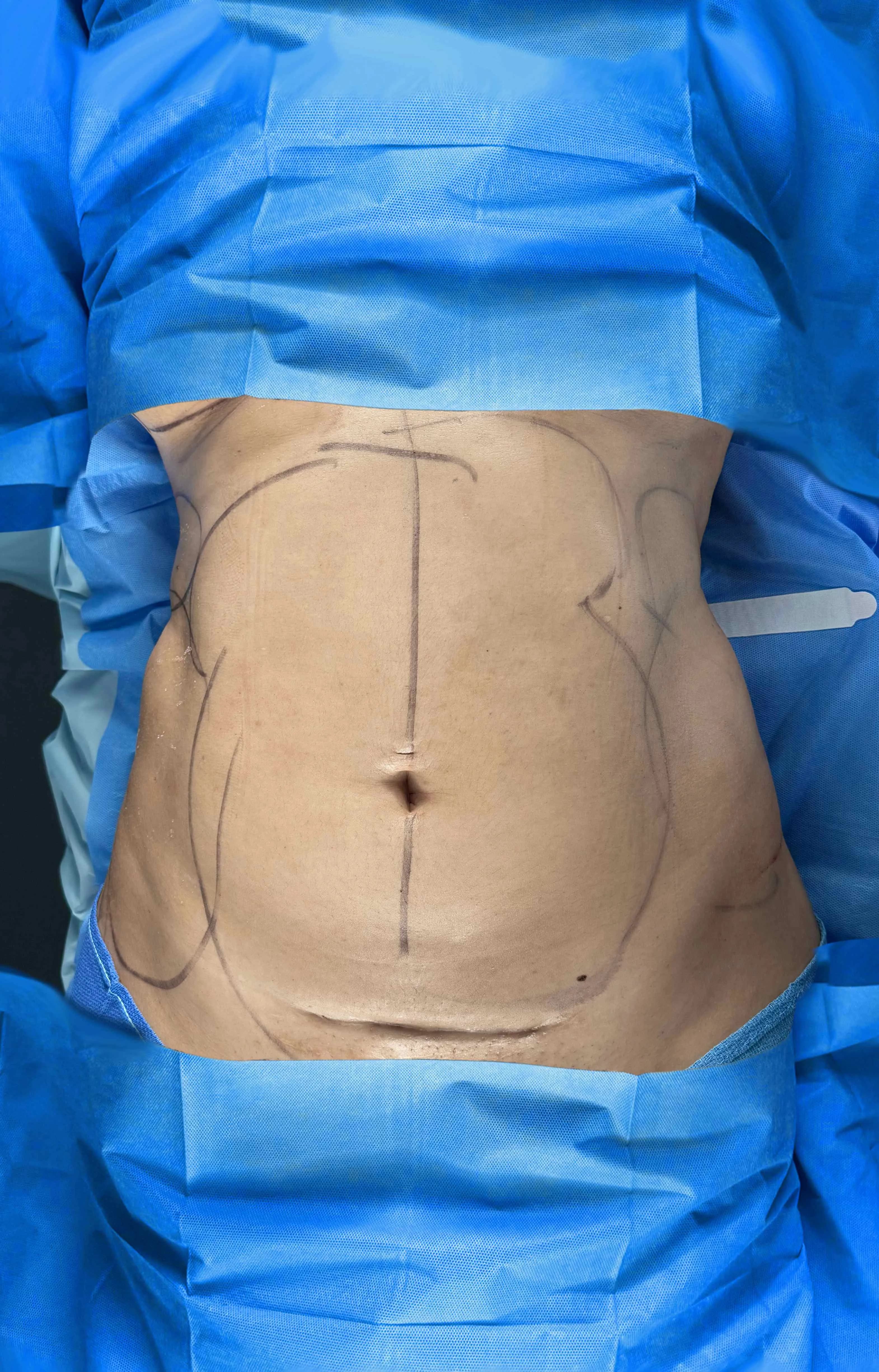 Liposucción y Lipo 360 antes por Dr. Oliver Simmons en Miami · Beautyland Plastic Surgery
