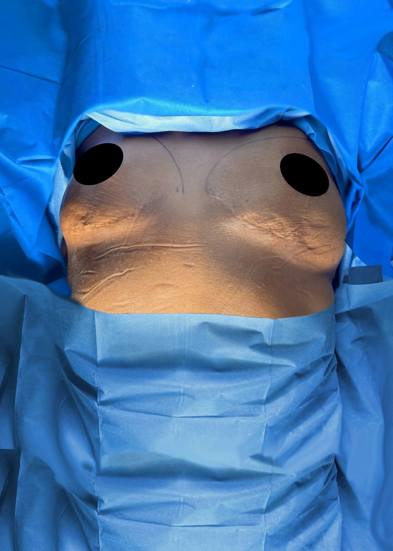 Mastopexia (elevación de senos) antes por Dr. Oliver Simmons en Miami · Beautyland Plastic Surgery