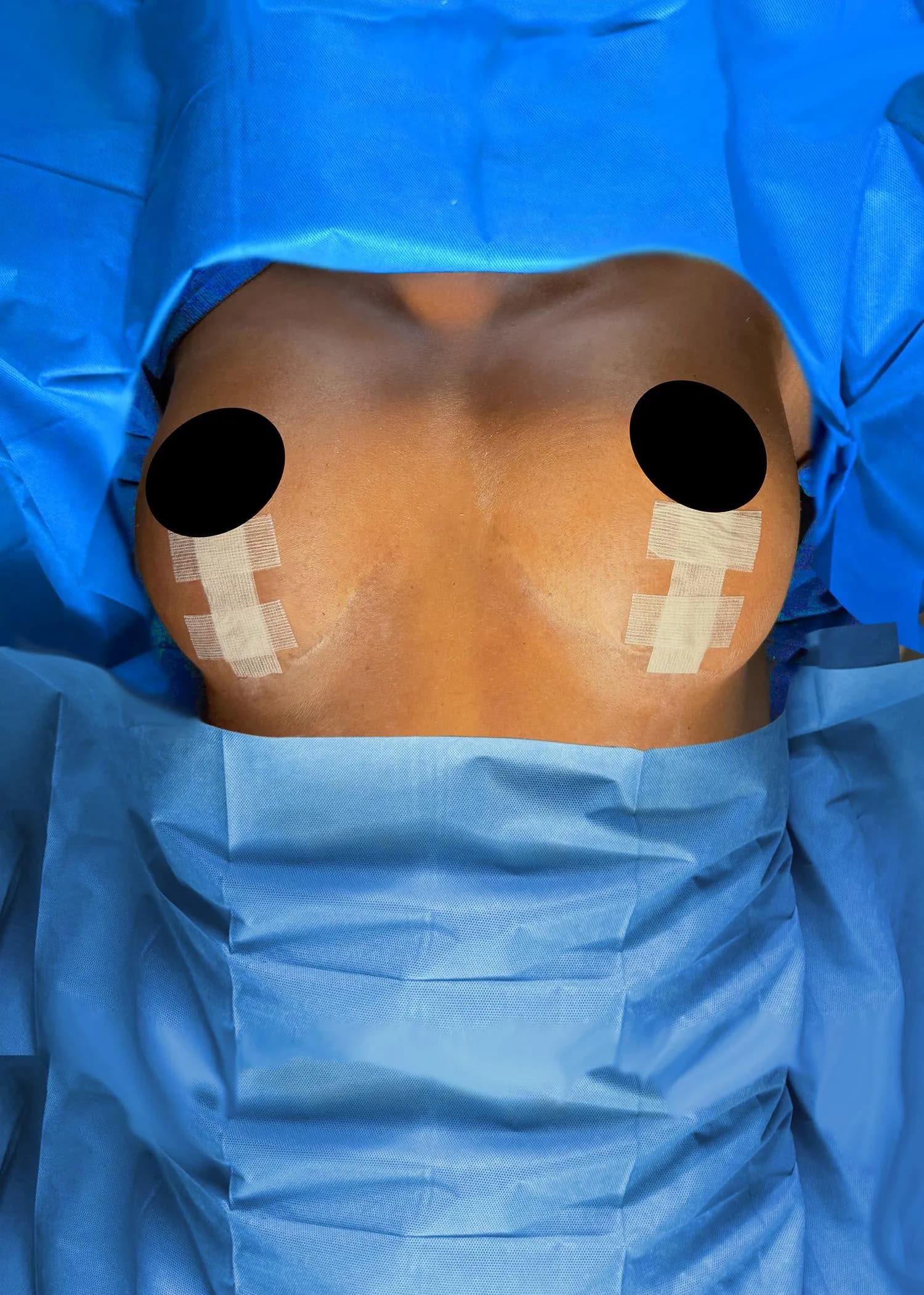 Mastopexia (elevación de senos) después por Dr. Oliver Simmons en Miami · Beautyland Plastic Surgery