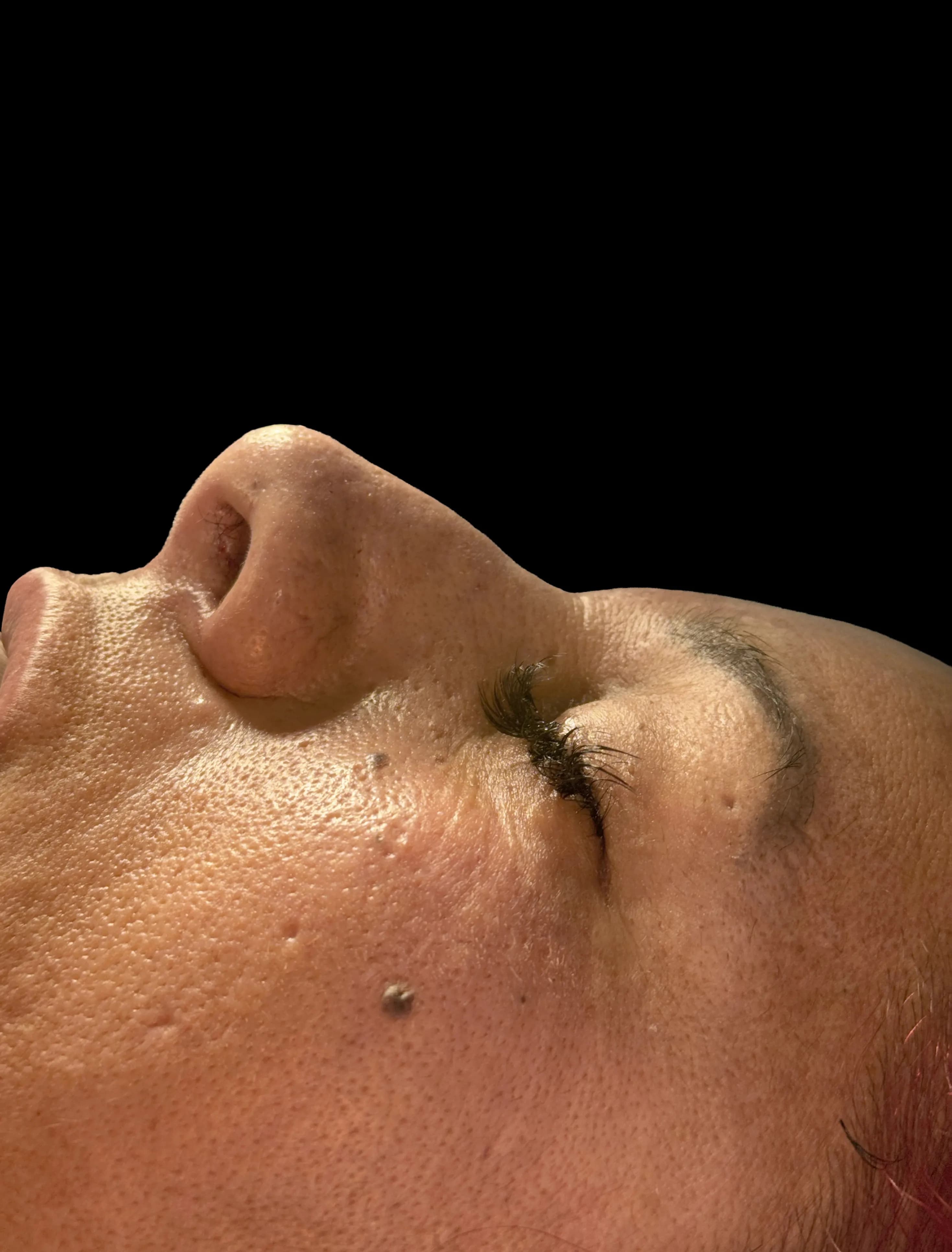 Rinoplastia antes por Dr. Oliver Simmons en Miami · Beautyland Plastic Surgery