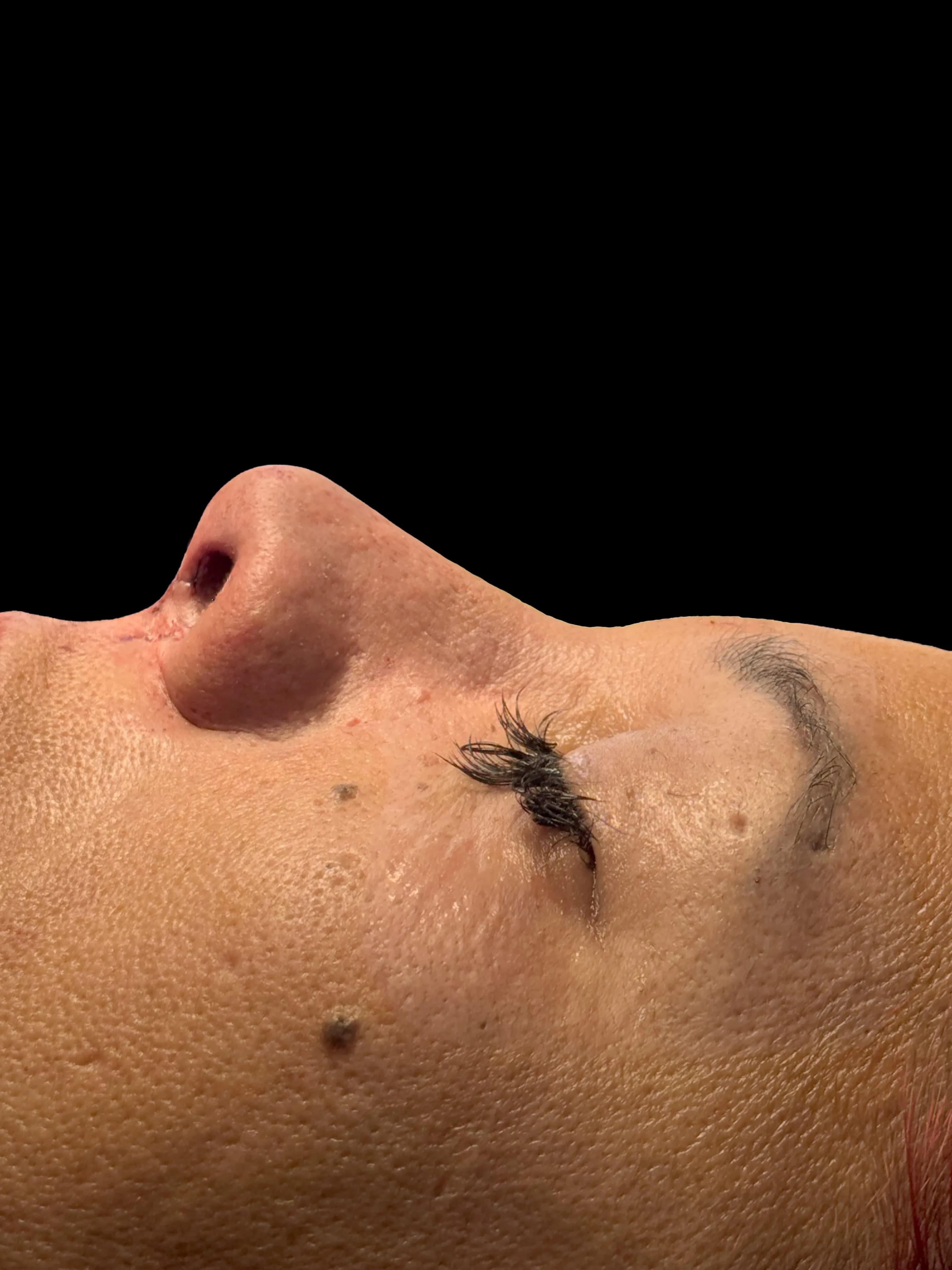 Rinoplastia después por Dr. Oliver Simmons en Miami · Beautyland Plastic Surgery