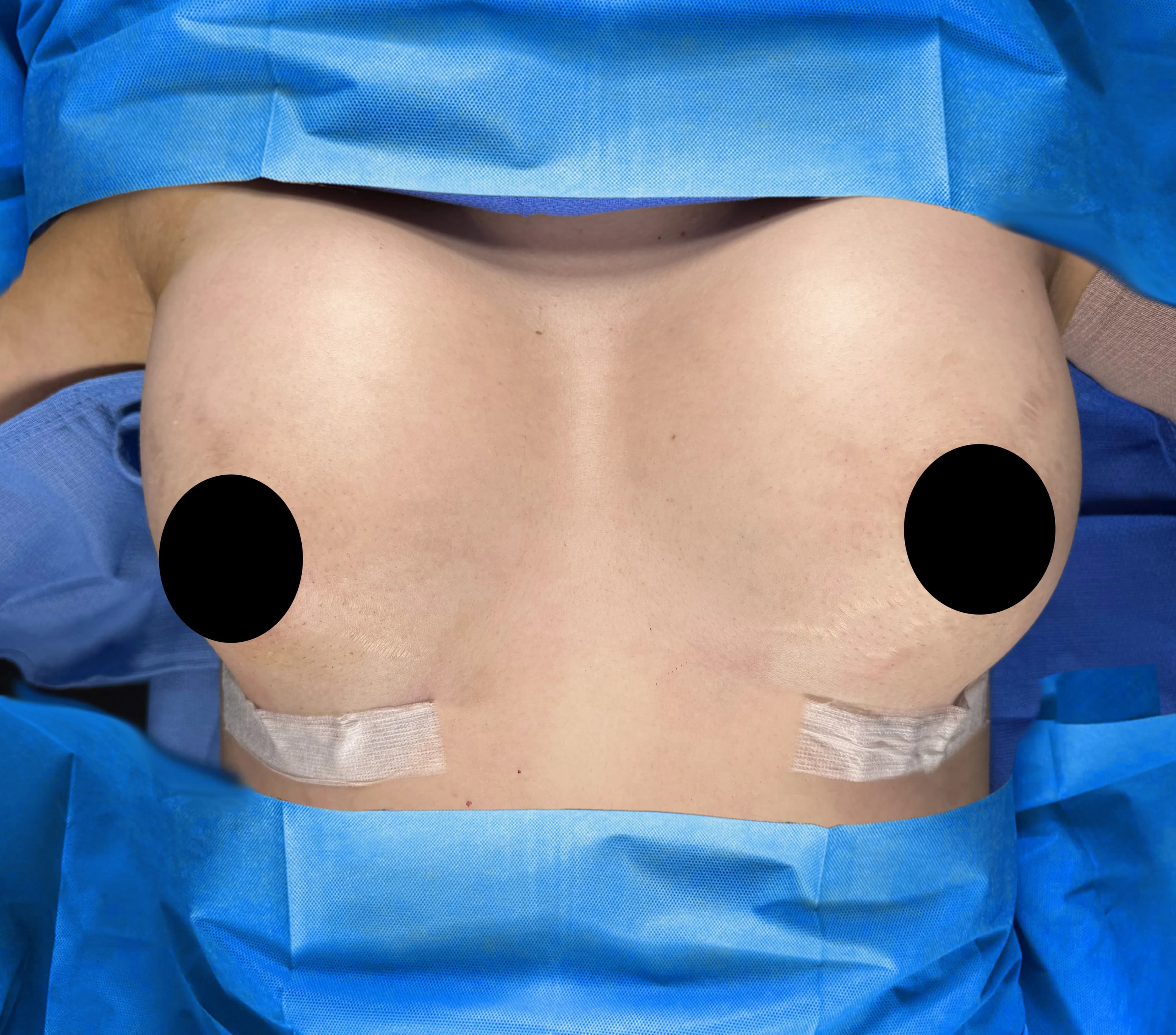 Breast Augmentation after by Dr. Anne-Sophie Lessard in Miami · Beautyland Plastic Surgery