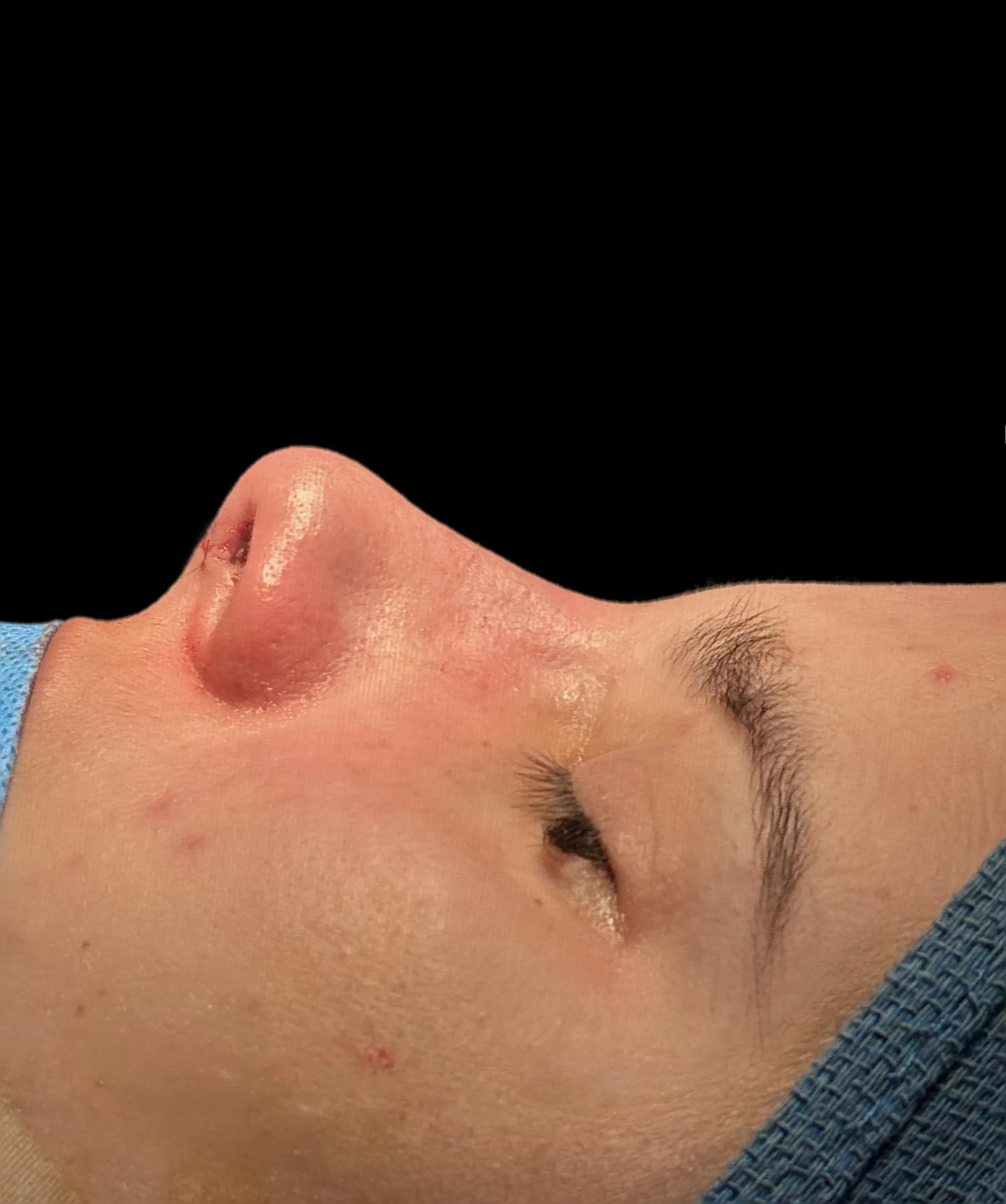 Rhinoplasty after by Dr. Oliver Simmons in Miami · Beautyland Plastic Surgery