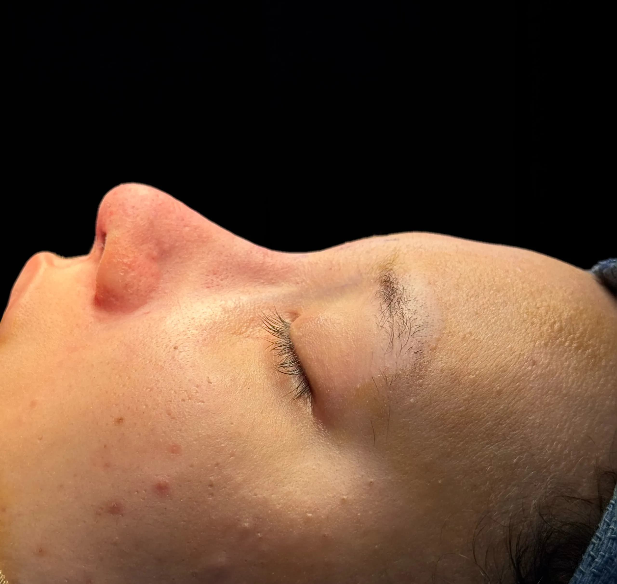 Rhinoplasty after by Dr. Oliver Simmons in Miami · Beautyland Plastic Surgery