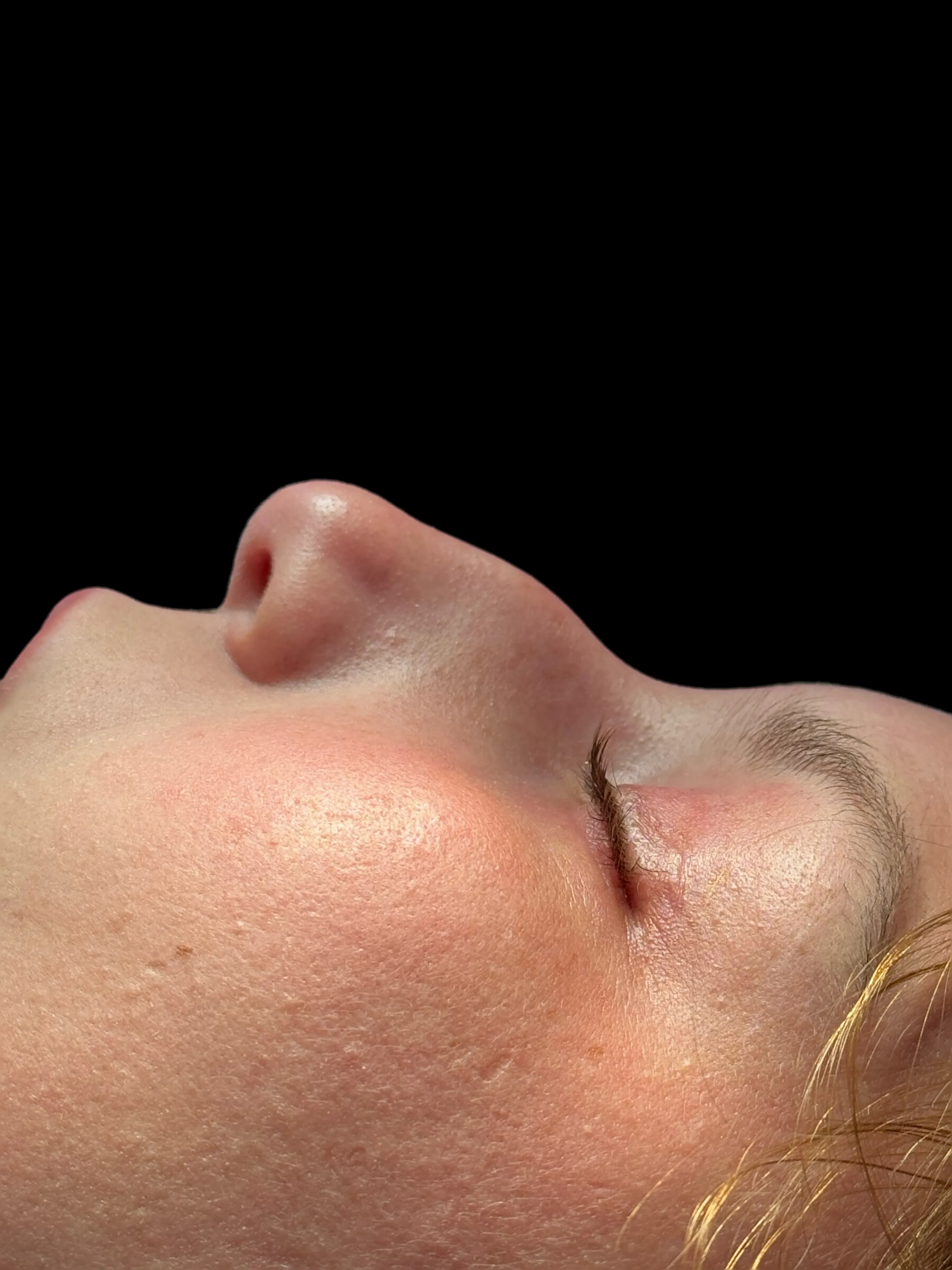 Rhinoplasty before by Dr. Oliver Simmons in Miami · Beautyland Plastic Surgery