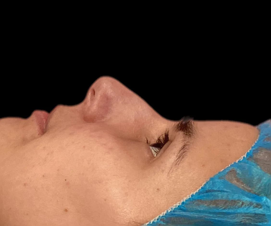 Rhinoplasty before by Dr. Oliver Simmons in Miami · Beautyland Plastic Surgery