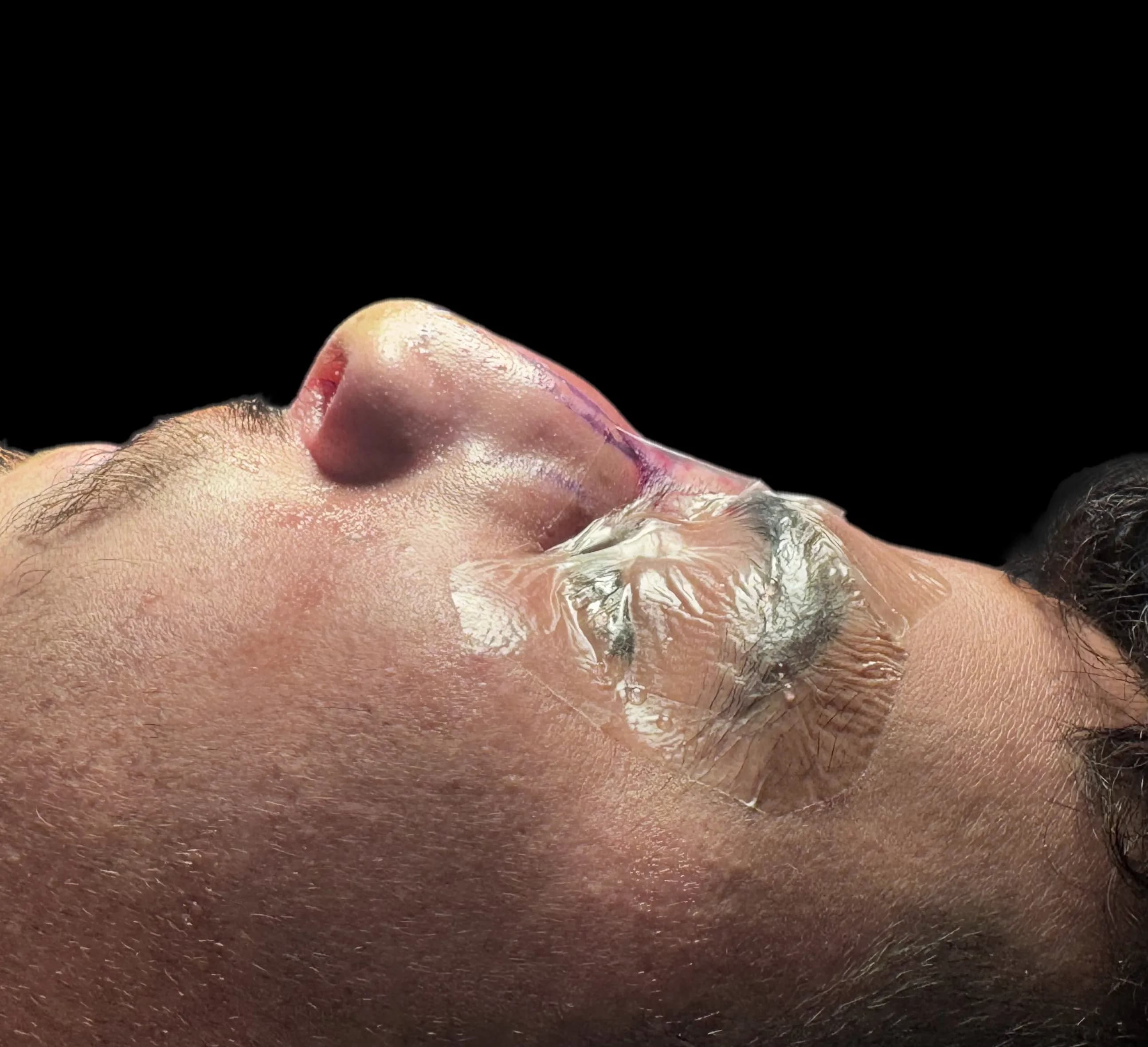 Rhinoplasty before by Dr. Oliver Simmons in Miami · Beautyland Plastic Surgery