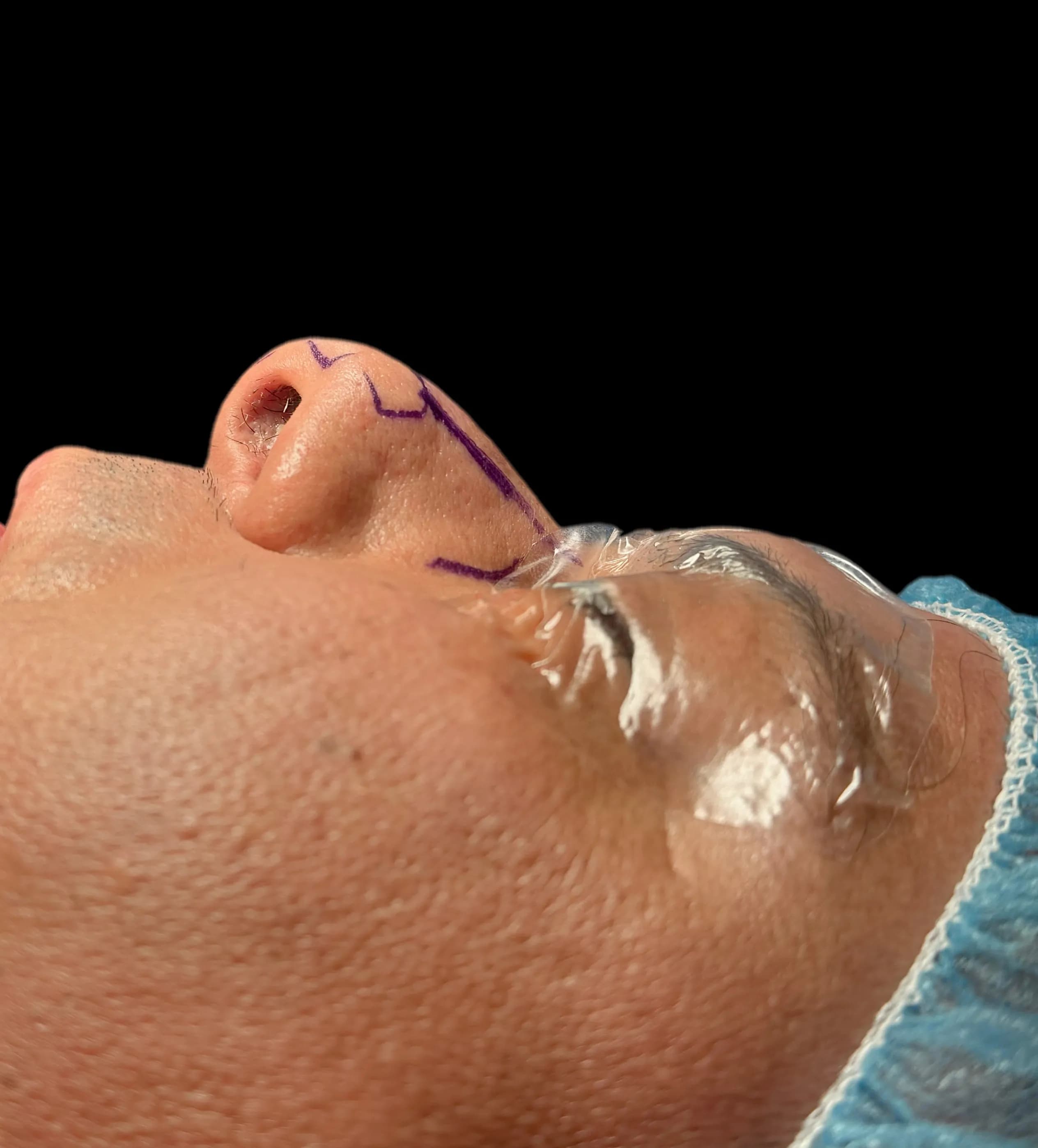 Rhinoplasty before by Dr. Oliver Simmons in Miami · Beautyland Plastic Surgery