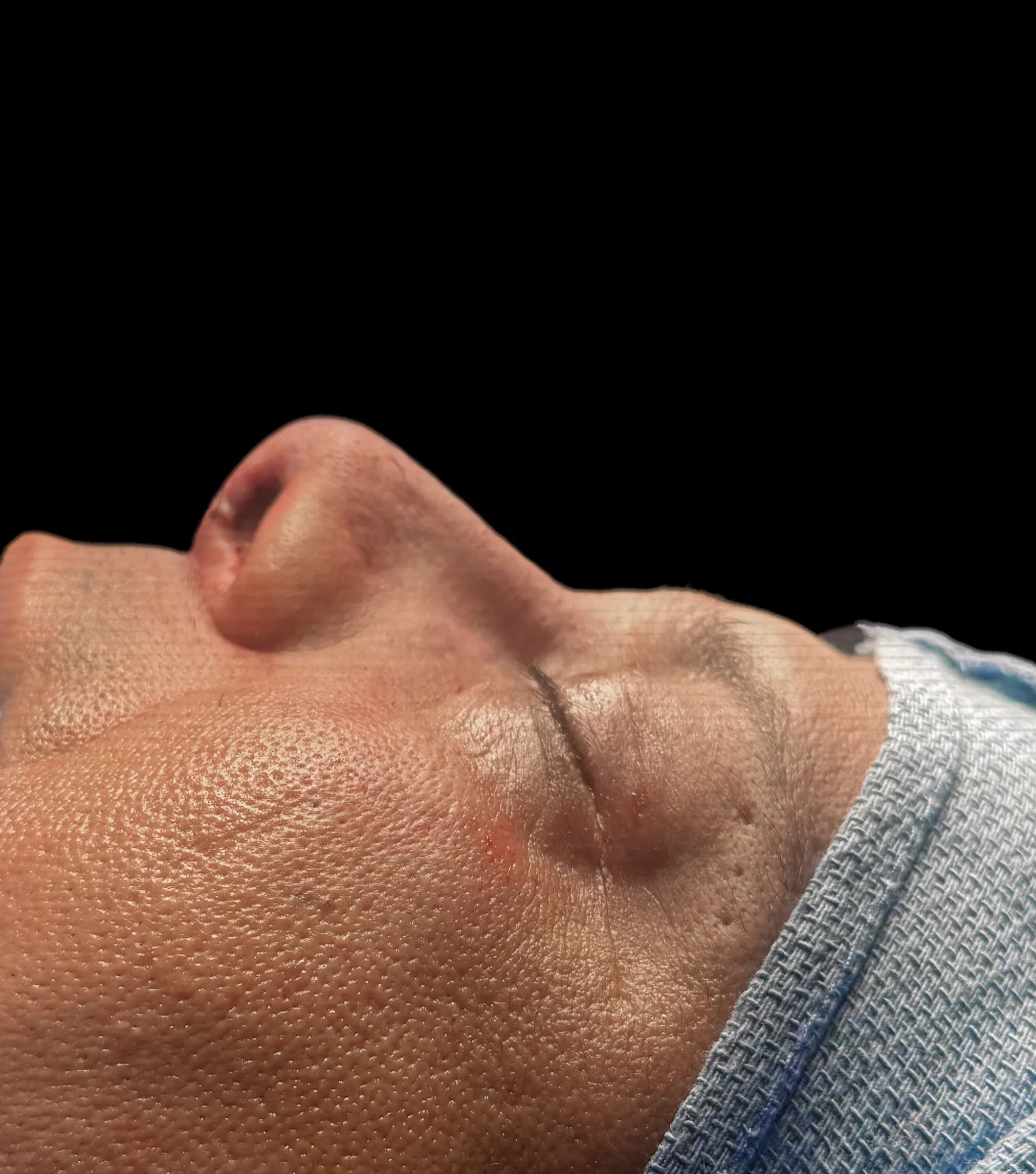 Rhinoplasty after by Dr. Oliver Simmons in Miami · Beautyland Plastic Surgery