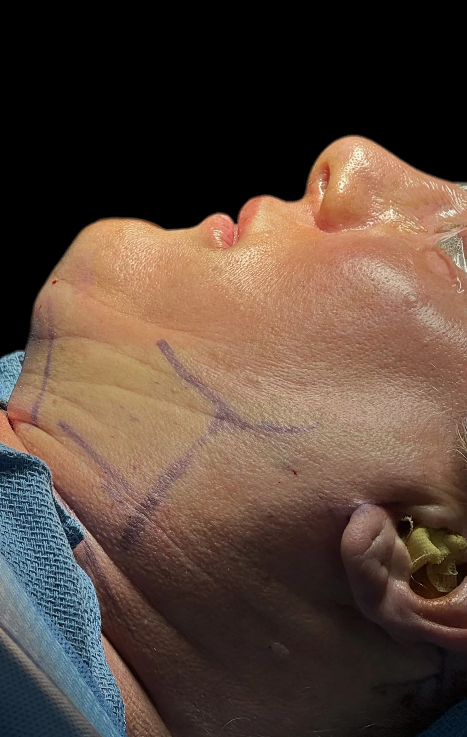 Rostro y cuello antes por Dr. Oliver Simmons en Miami · Beautyland Plastic Surgery