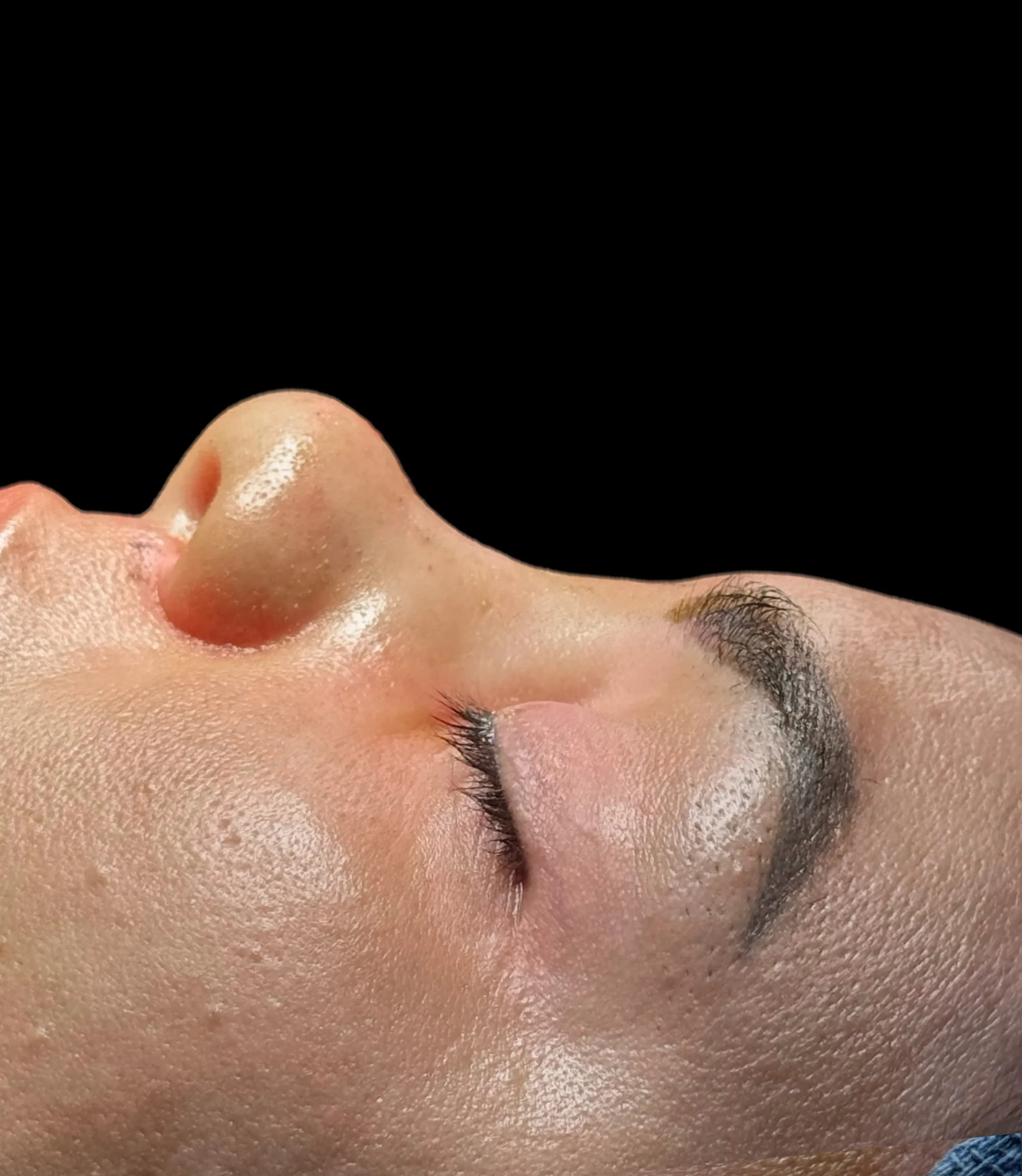 Rinoplastia antes por Dr. Oliver Simmons en Miami · Beautyland Plastic Surgery