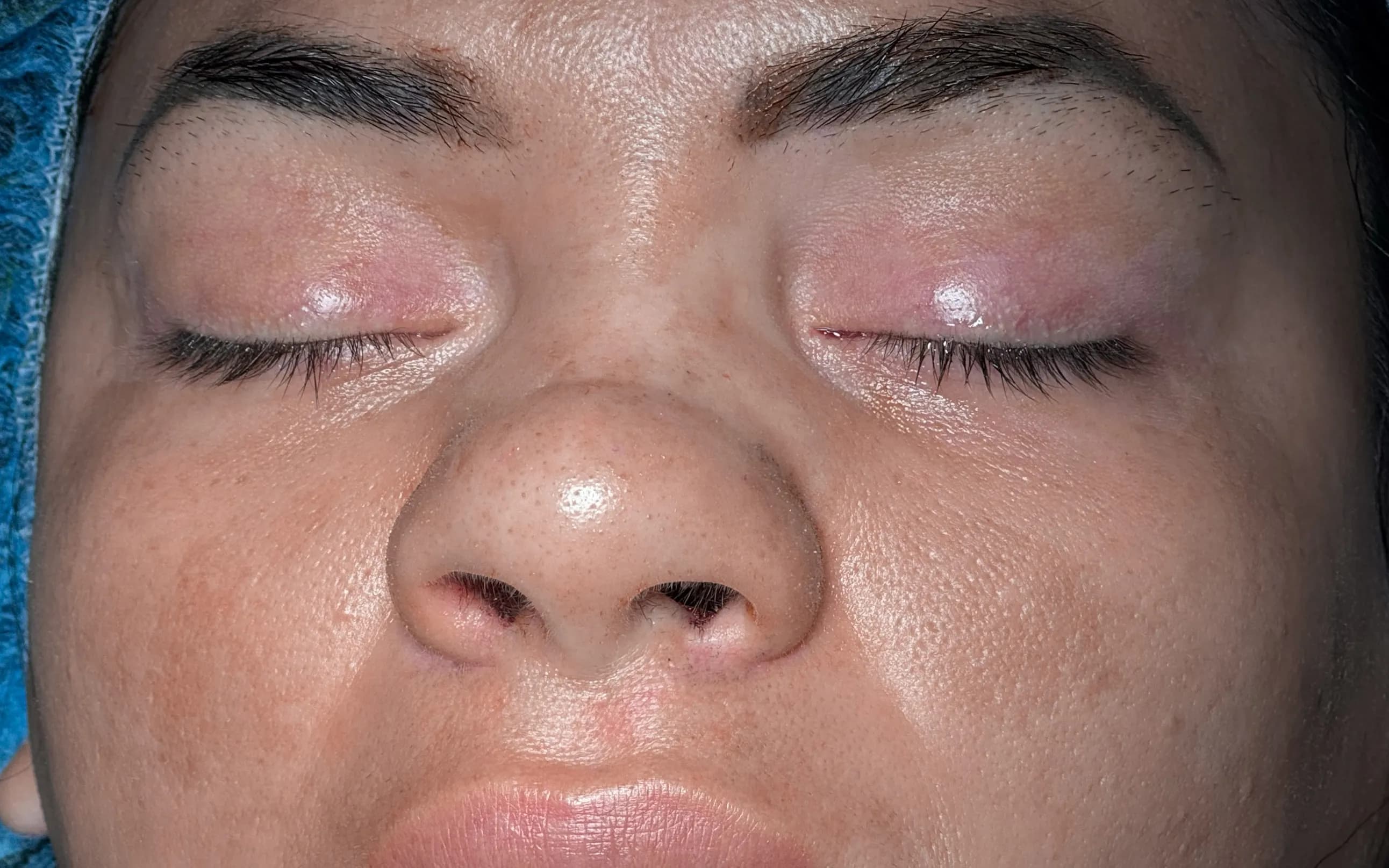 Rinoplastia antes por Dr. Oliver Simmons en Miami · Beautyland Plastic Surgery