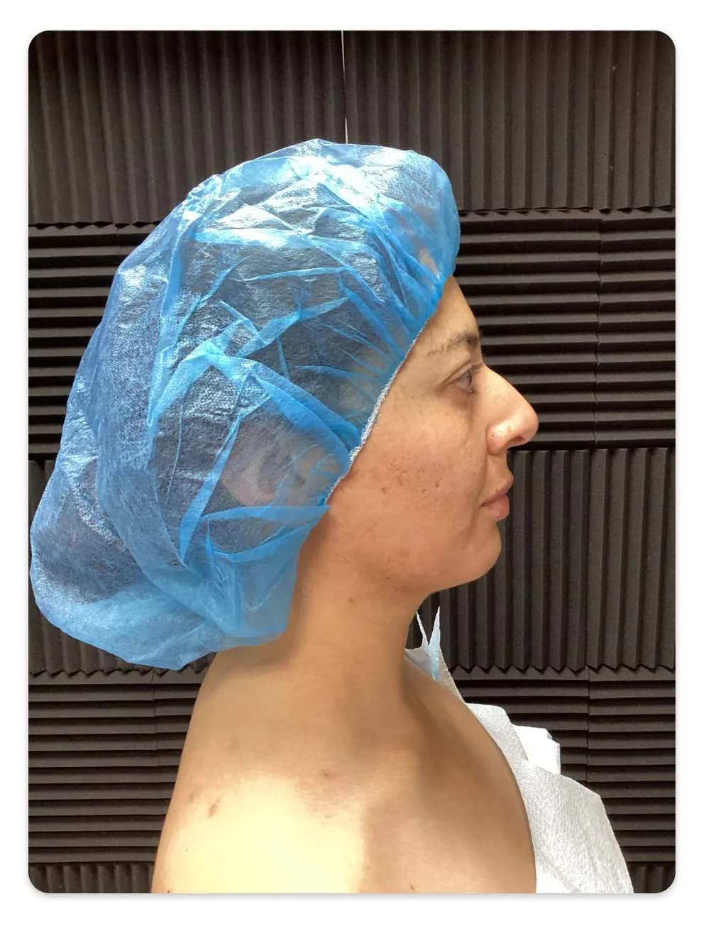 Rhinoplasty before by Dr. Oliver Simmons in Miami · Beautyland Plastic Surgery