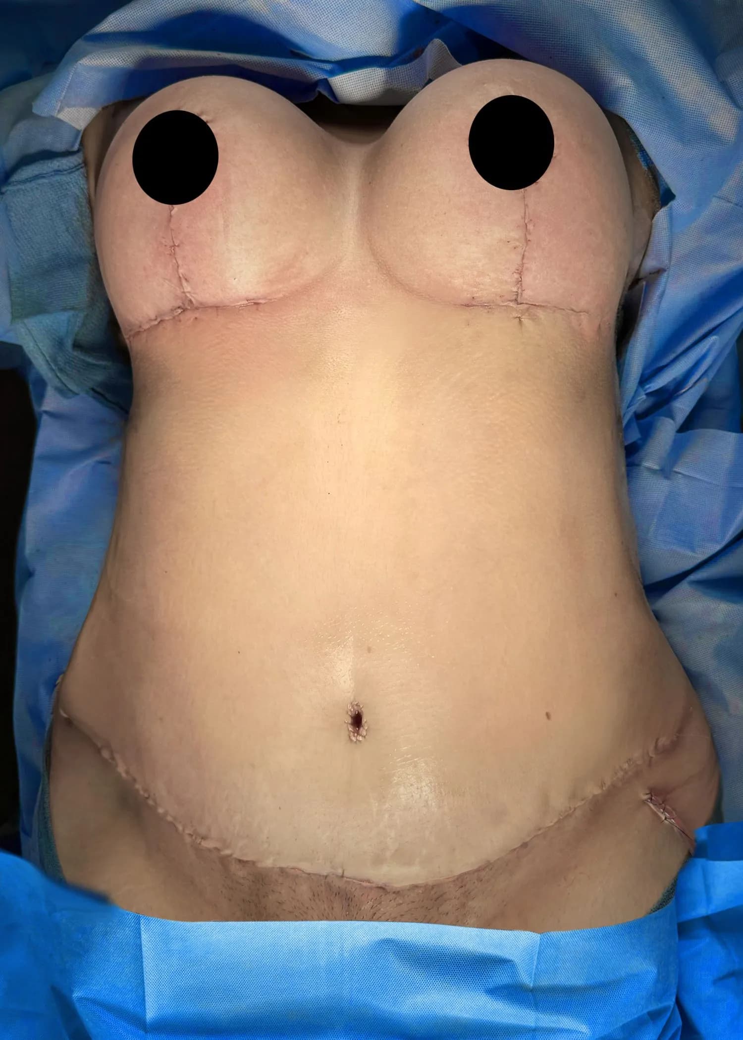 Mommy Makeover after by Dr. Anne-Sophie Lessard in Miami · Beautyland Plastic Surgery