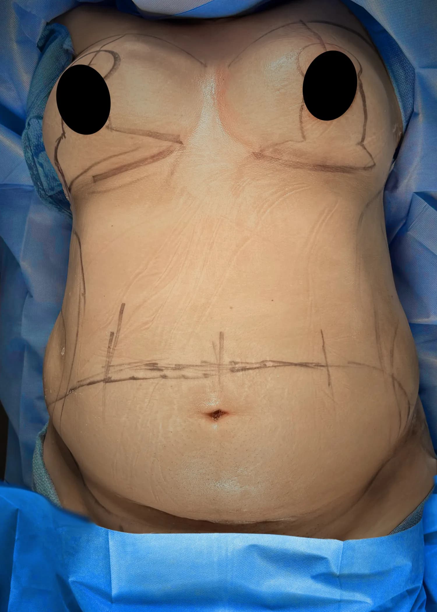 Mommy Makeover before by Dr. Anne-Sophie Lessard in Miami · Beautyland Plastic Surgery