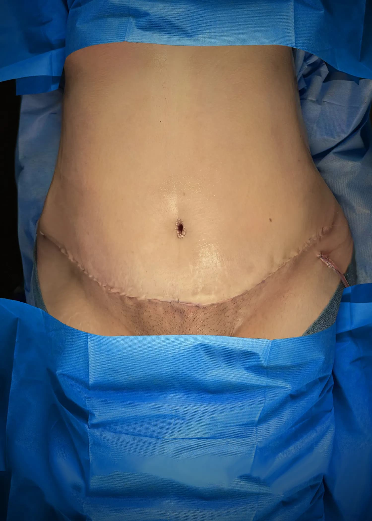 Tummy Tuck after · Dr. Anne-Sophie Lessard M.D, Miami