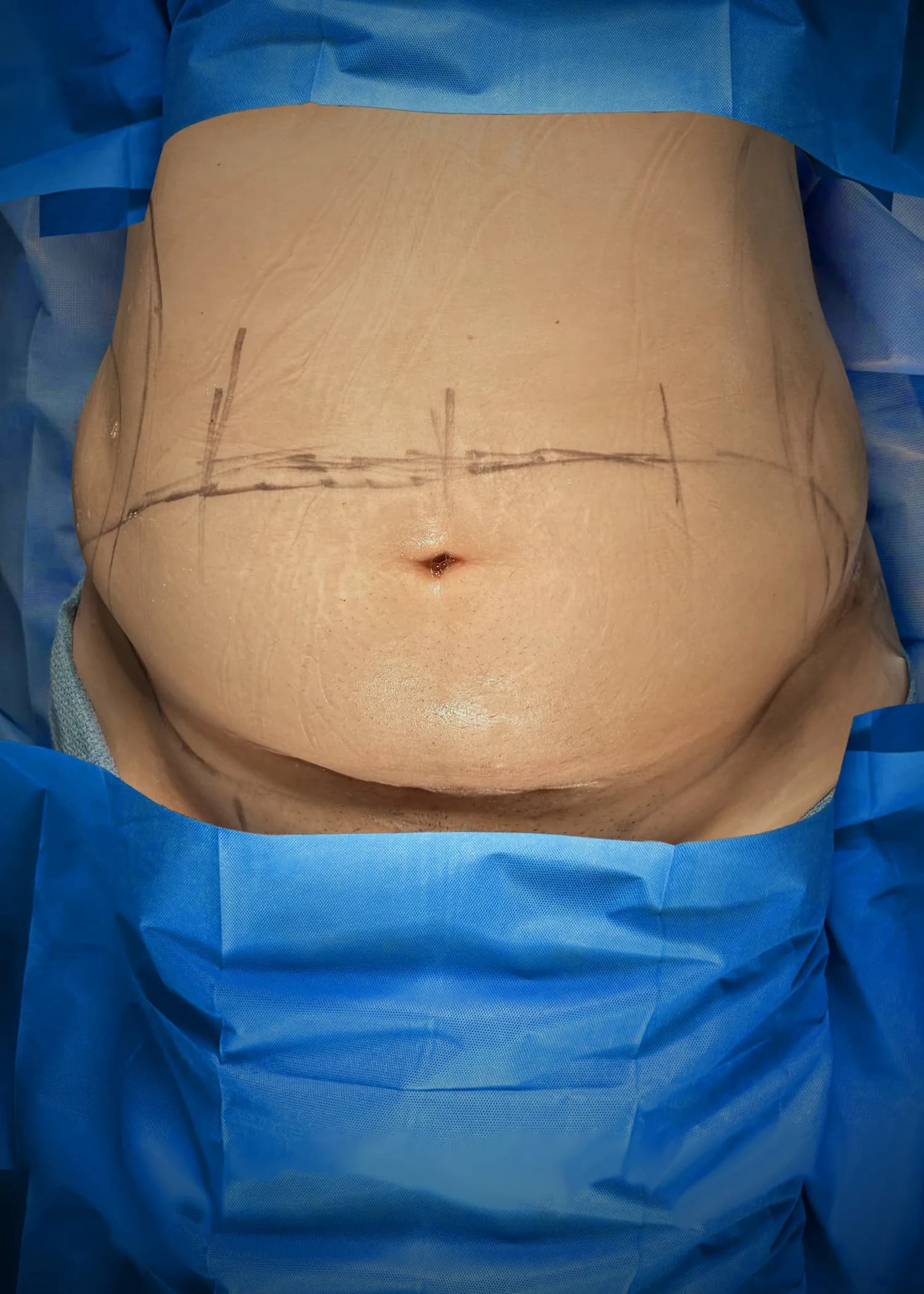 Tummy Tuck before · Dr. Anne-Sophie Lessard M.D, Miami