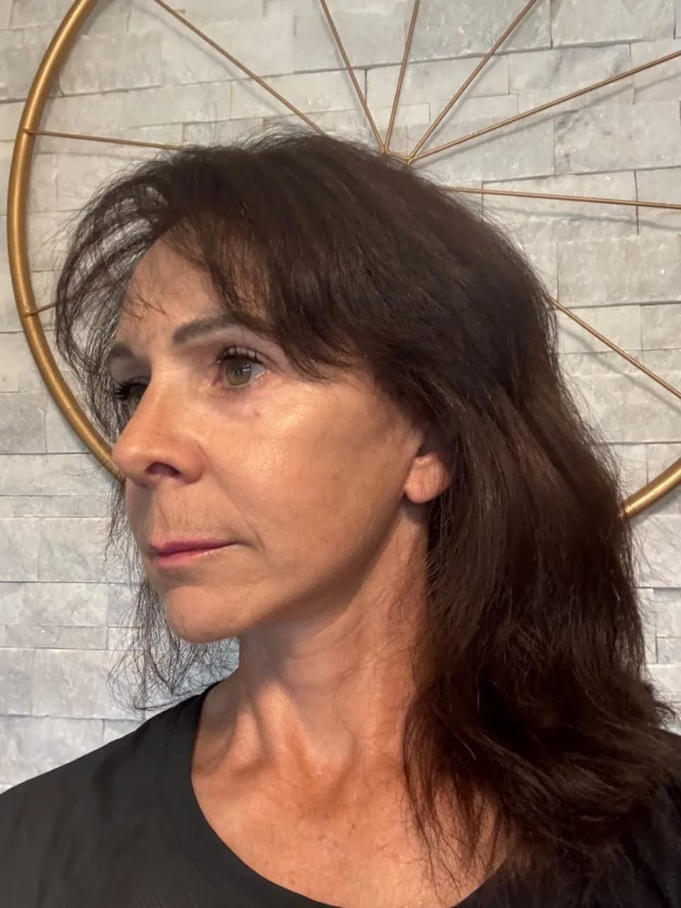 Rostro y cuello después por Dr. Oliver Simmons en Miami · Beautyland Plastic Surgery