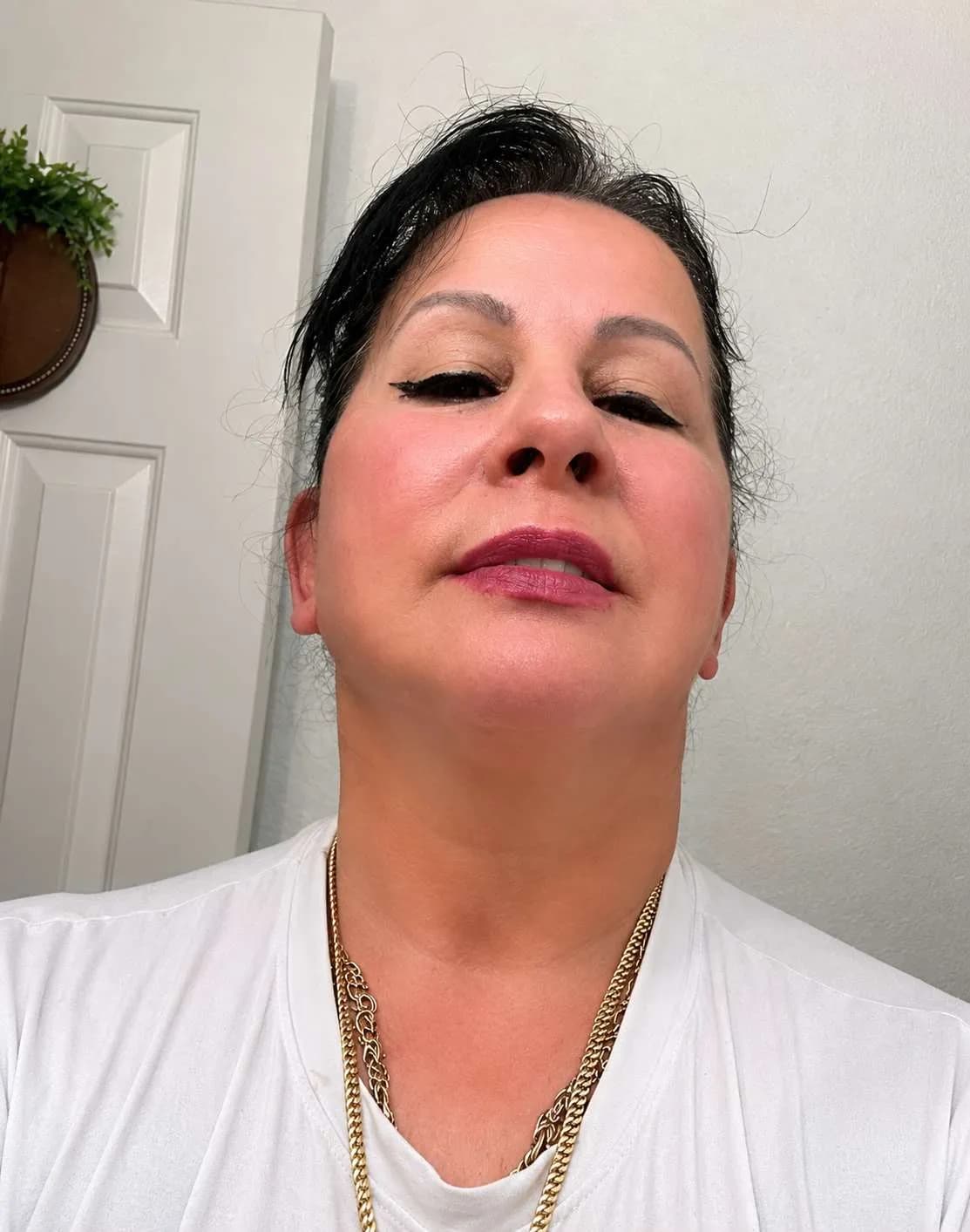 Face and neck procedures after by Dr. Oliver Simmons in Miami · Beautyland Plastic Surgery