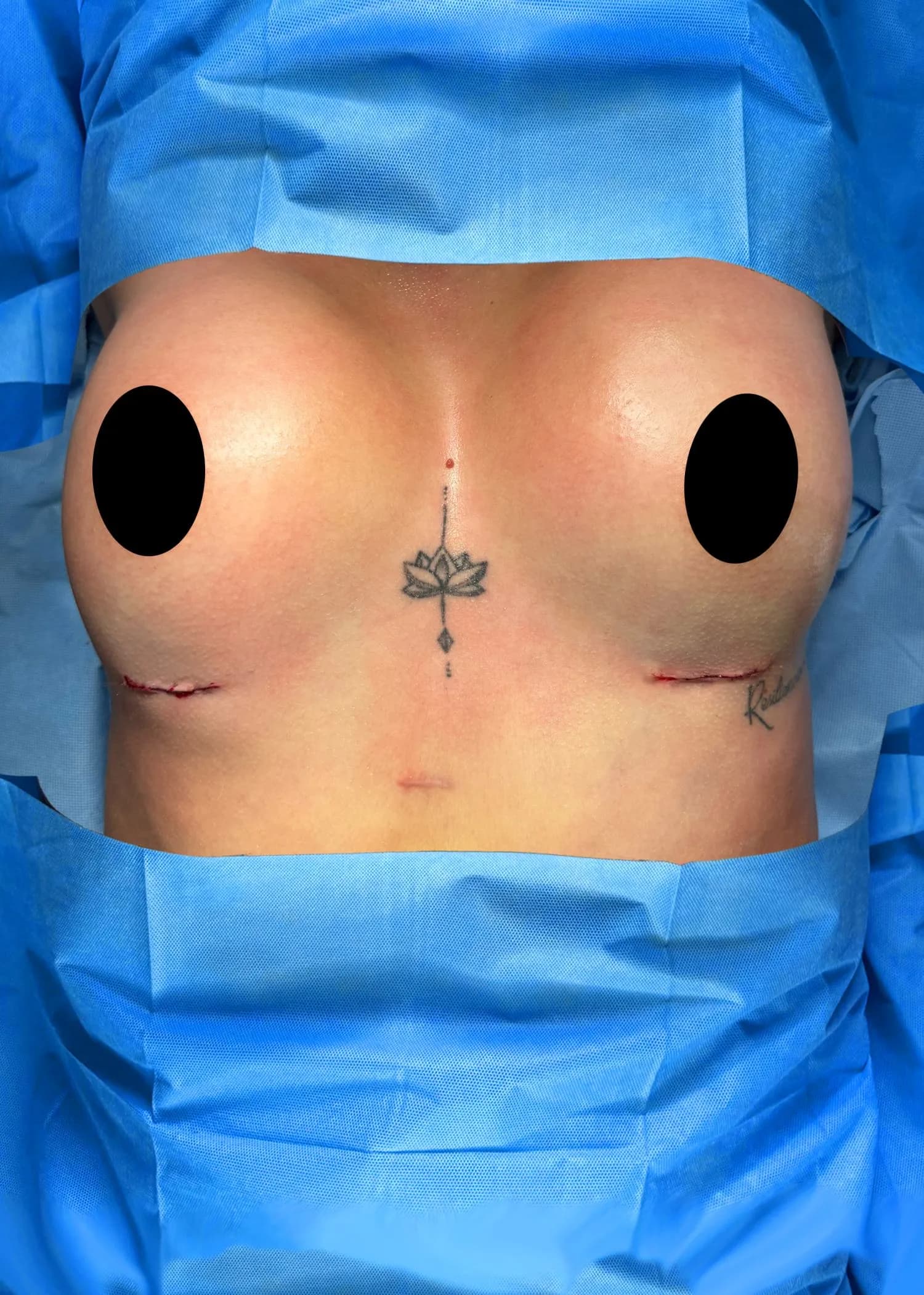 Breast Augmentation after · Dr. Oliver Simmons M.D, Miami