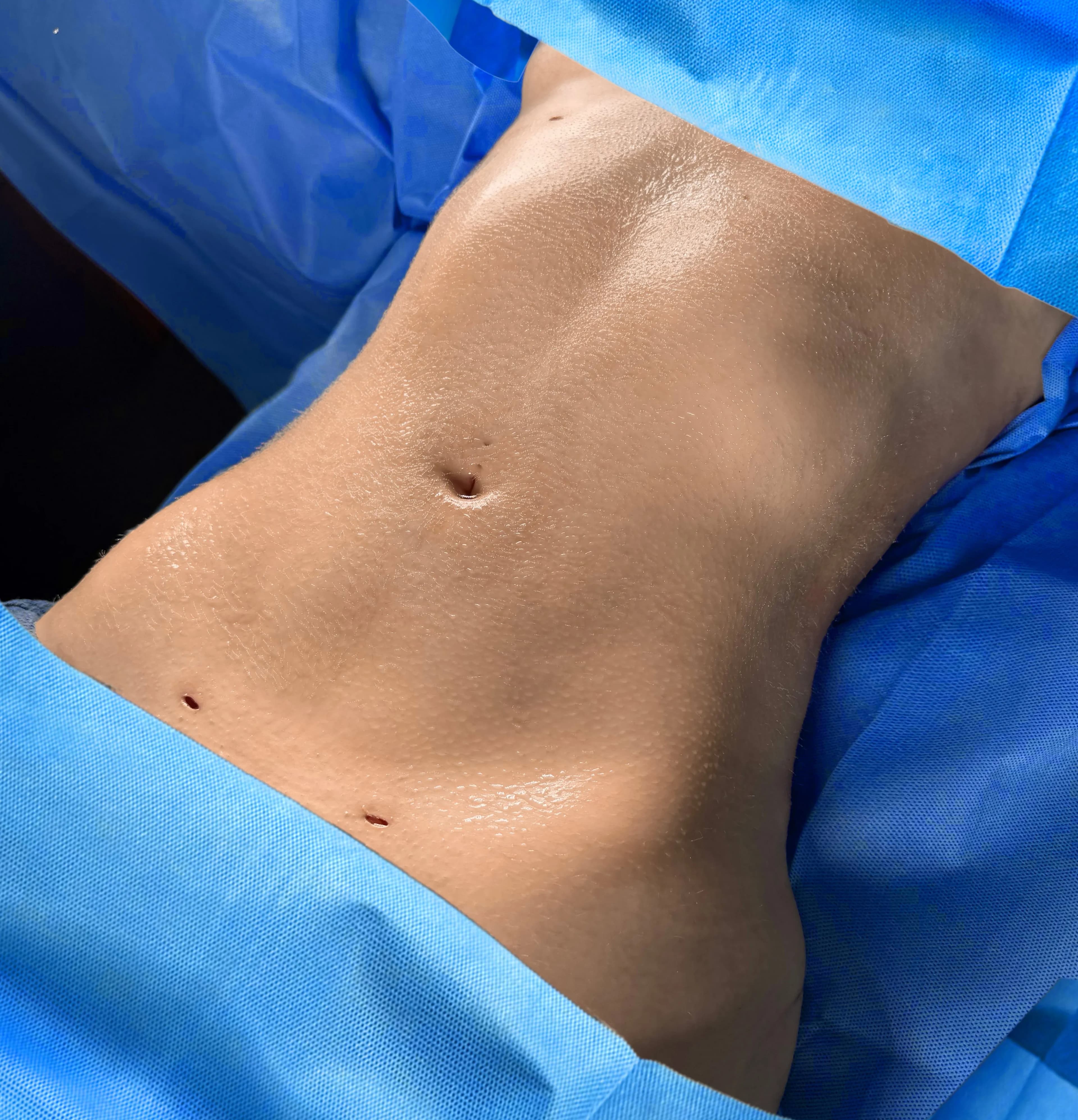 Liposuction & Lipo 360 after by Dr. Oliver Simmons in Miami · Beautyland Plastic Surgery