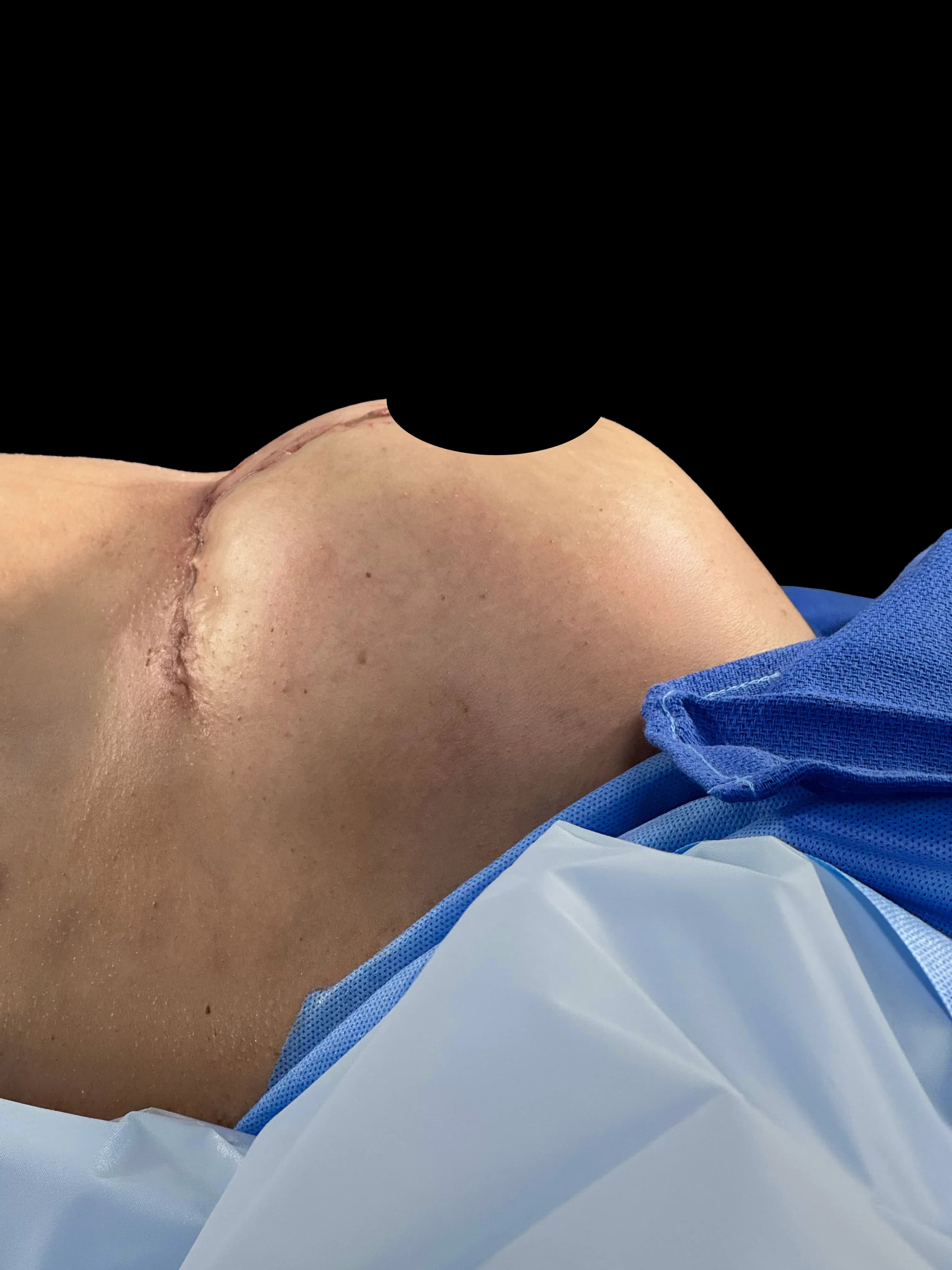 Breast Lift after by Dr. Oliver Simmons in Miami · Beautyland Plastic Surgery