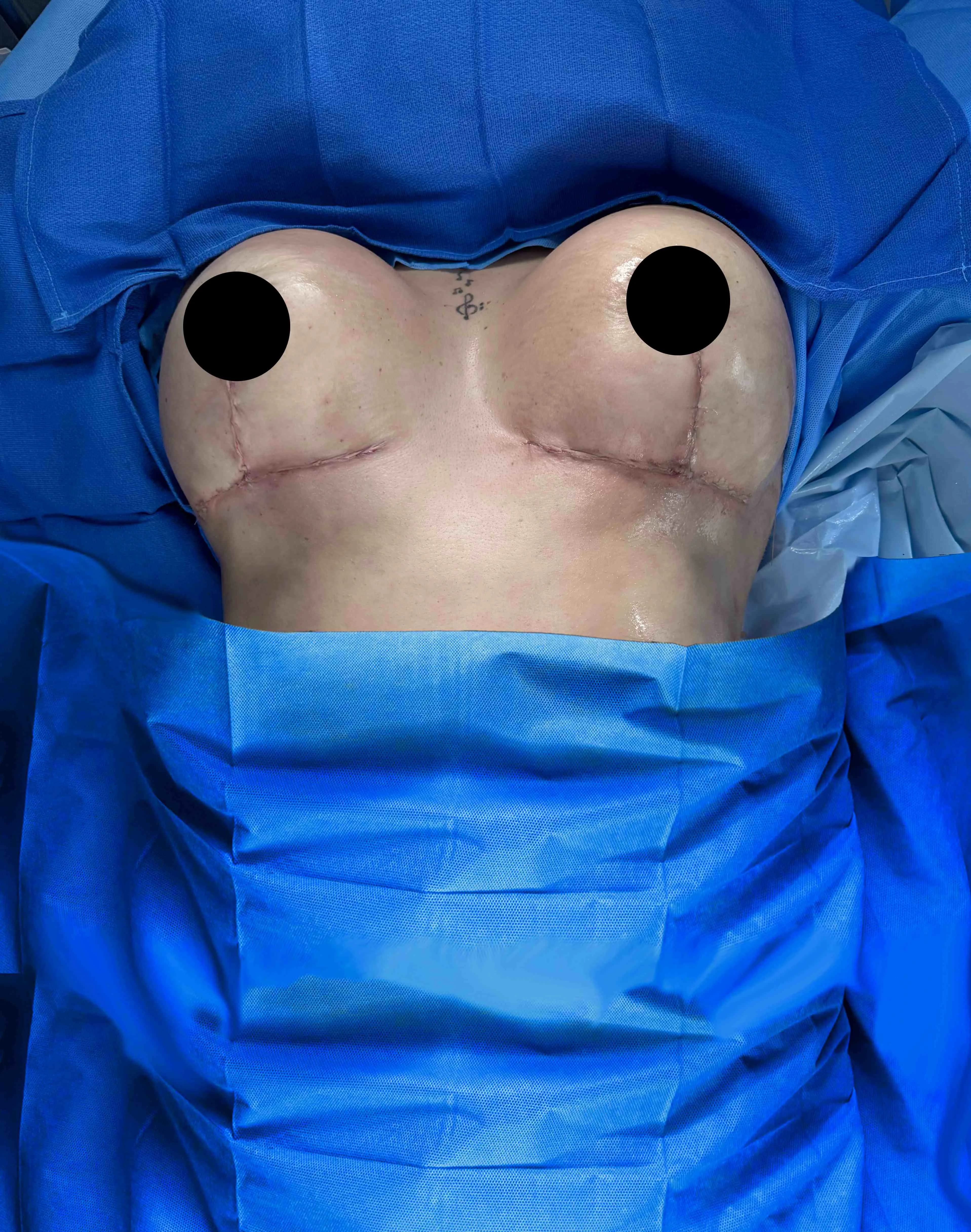 Breast Lift after by Dr. Oliver Simmons in Miami · Beautyland Plastic Surgery