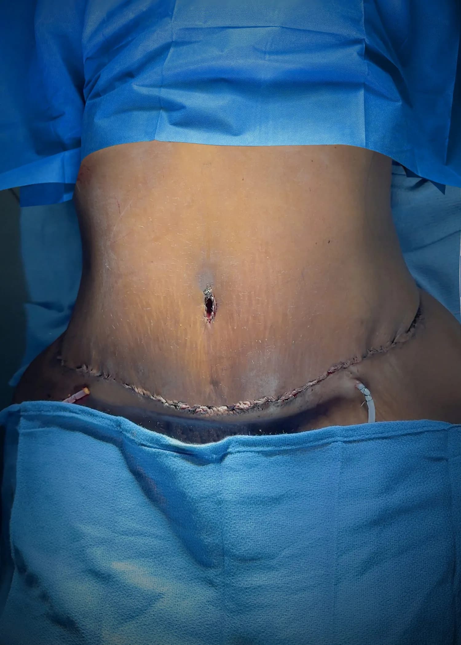 Abdominoplastia después por Dr. Oliver Simmons en Miami · Beautyland Plastic Surgery