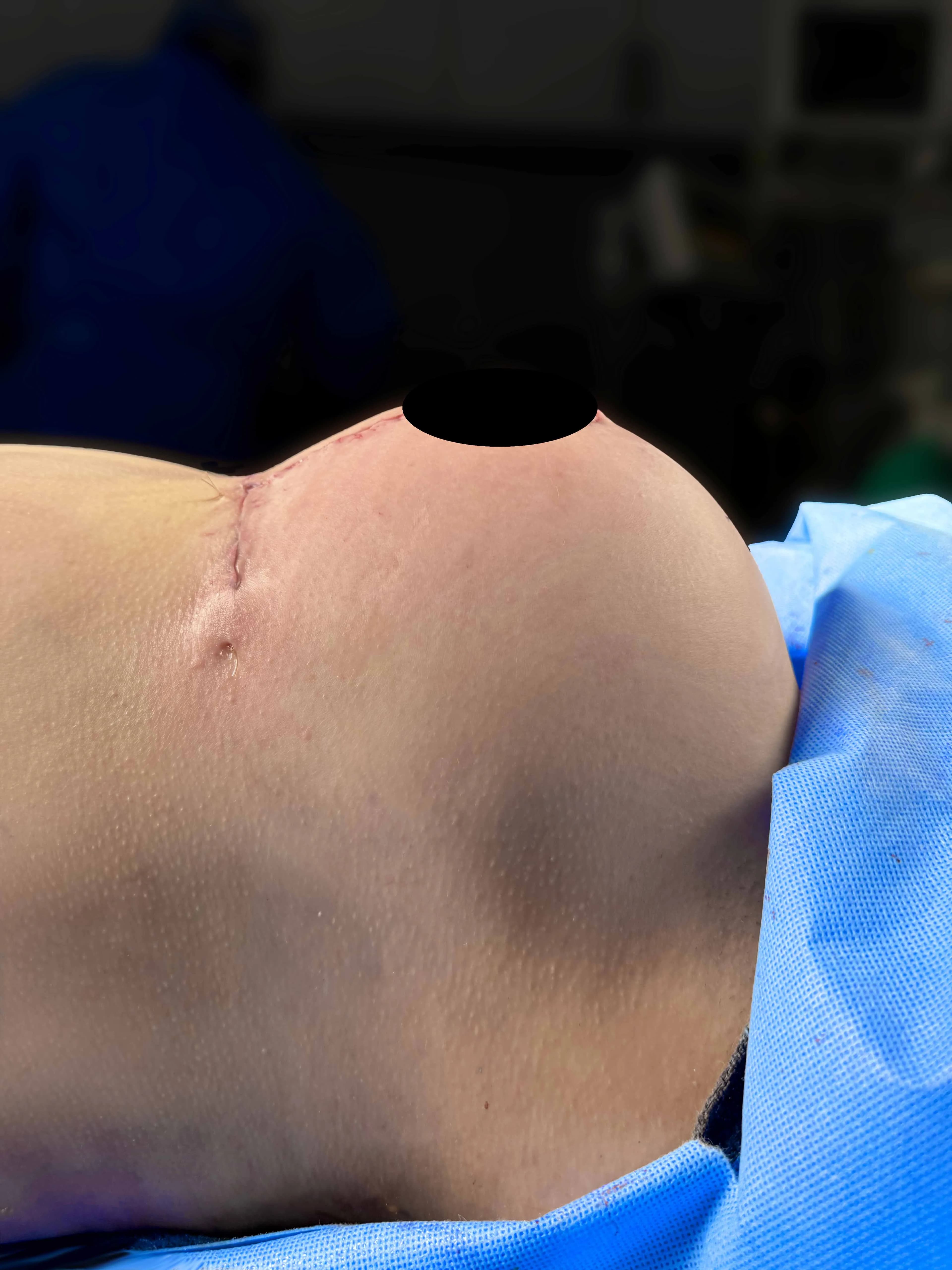 Breast Lift after · Dr. Anne-Sophie Lessard M.D, Miami