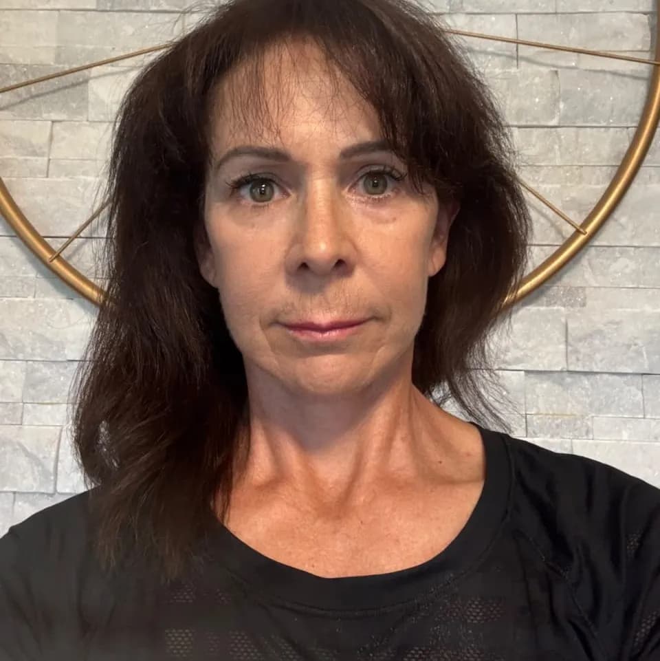 Rostro y cuello después por Dr. Oliver Simmons en Miami · Beautyland Plastic Surgery