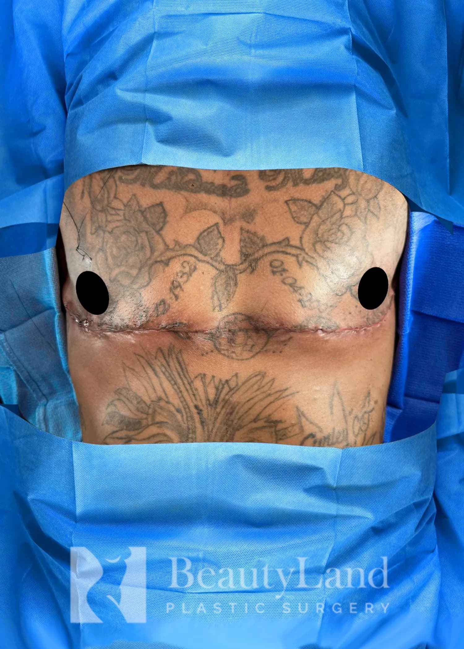 Reducción de senos después por Dr. Christopher J. Salgado en Miami · Beautyland Plastic Surgery