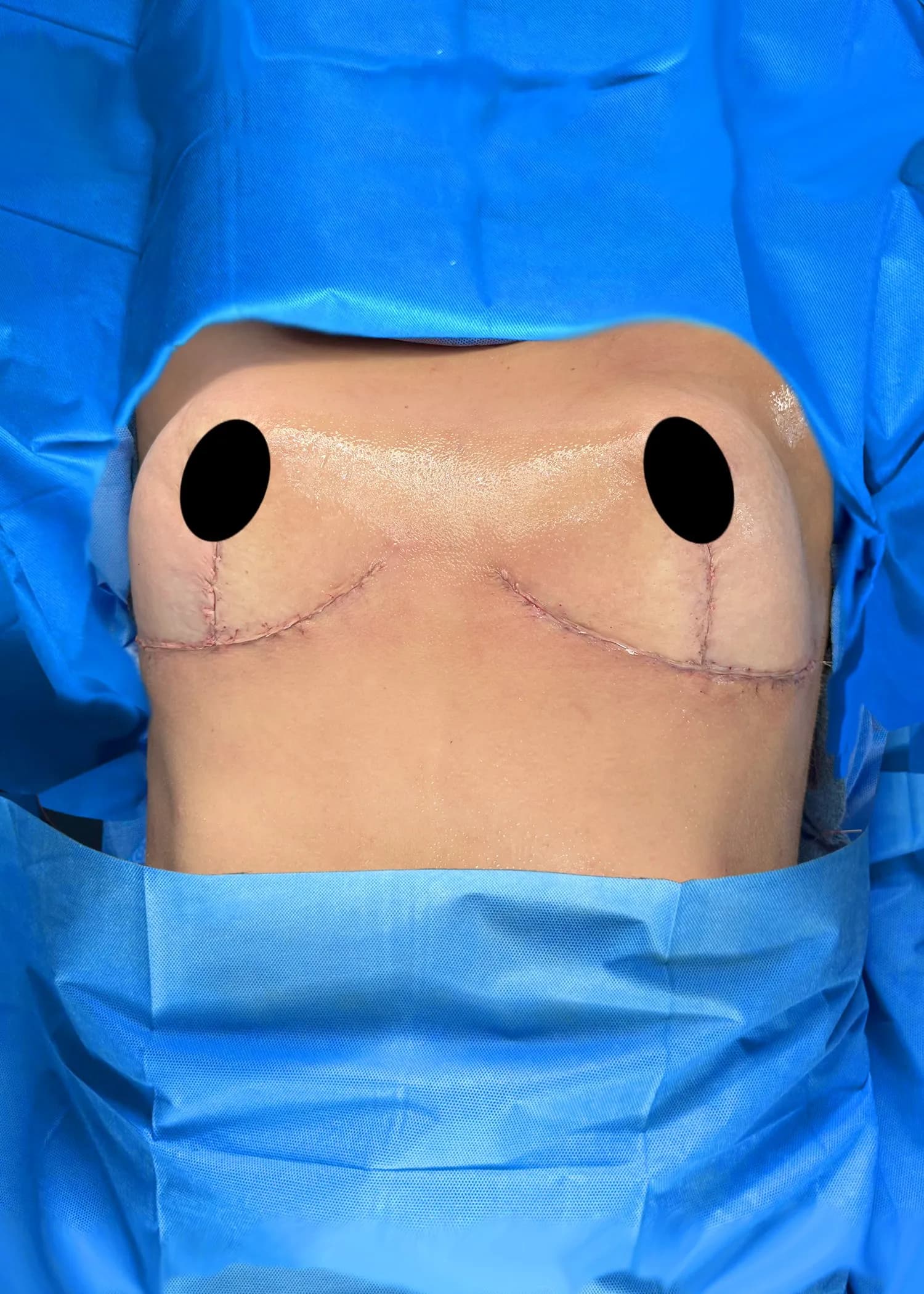 Breast Lift after by Dr. Oliver Simmons in Miami · Beautyland Plastic Surgery