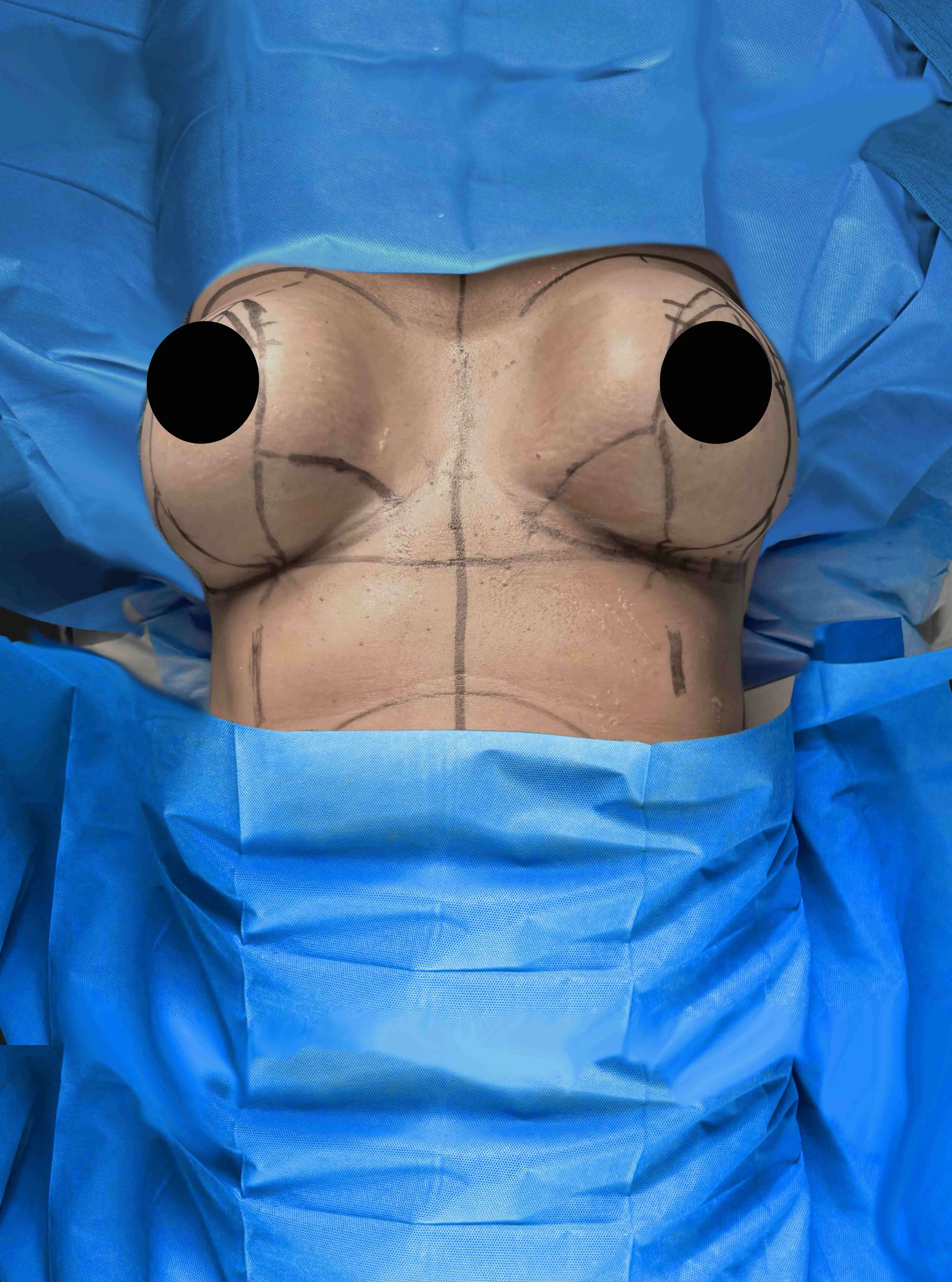 Breast Lift before by Dr. Anne-Sophie Lessard in Miami · Beautyland Plastic Surgery