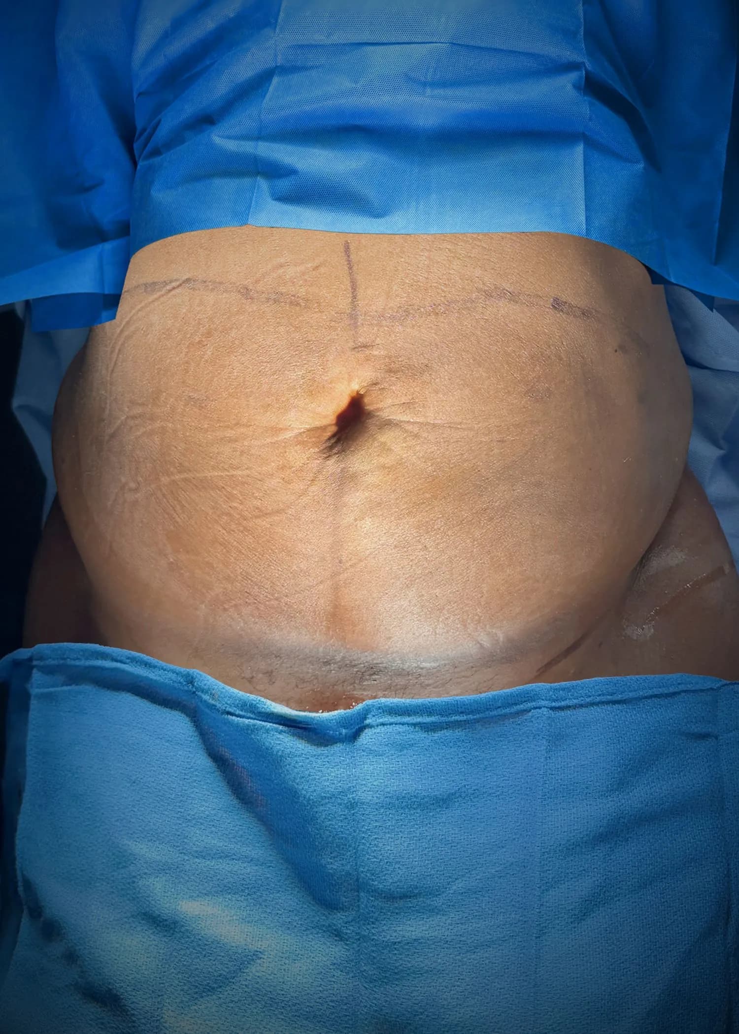 Abdominoplastia antes por Dr. Oliver Simmons en Miami · Beautyland Plastic Surgery