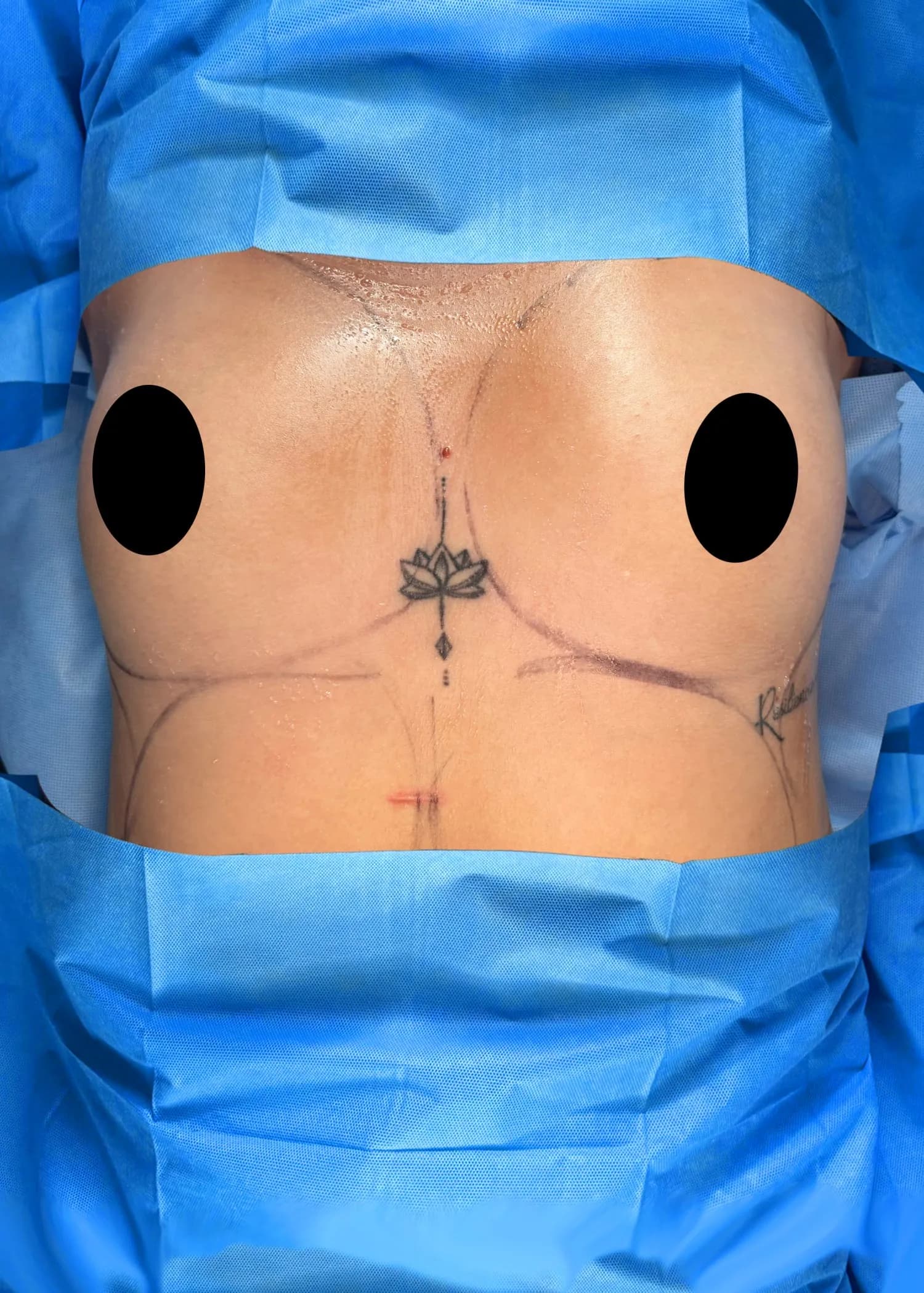 Breast Augmentation before · Dr. Oliver Simmons M.D, Miami