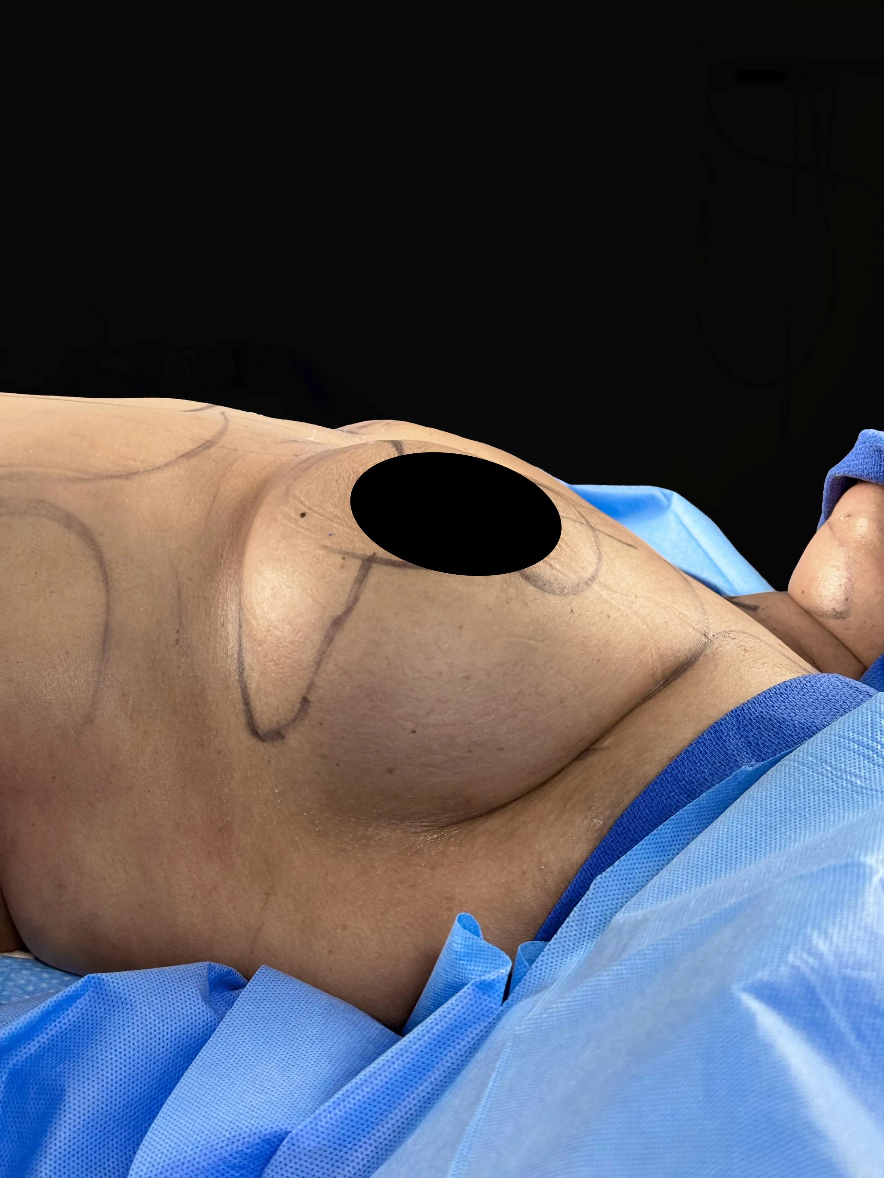 Breast Lift before by Dr. Oliver Simmons in Miami · Beautyland Plastic Surgery